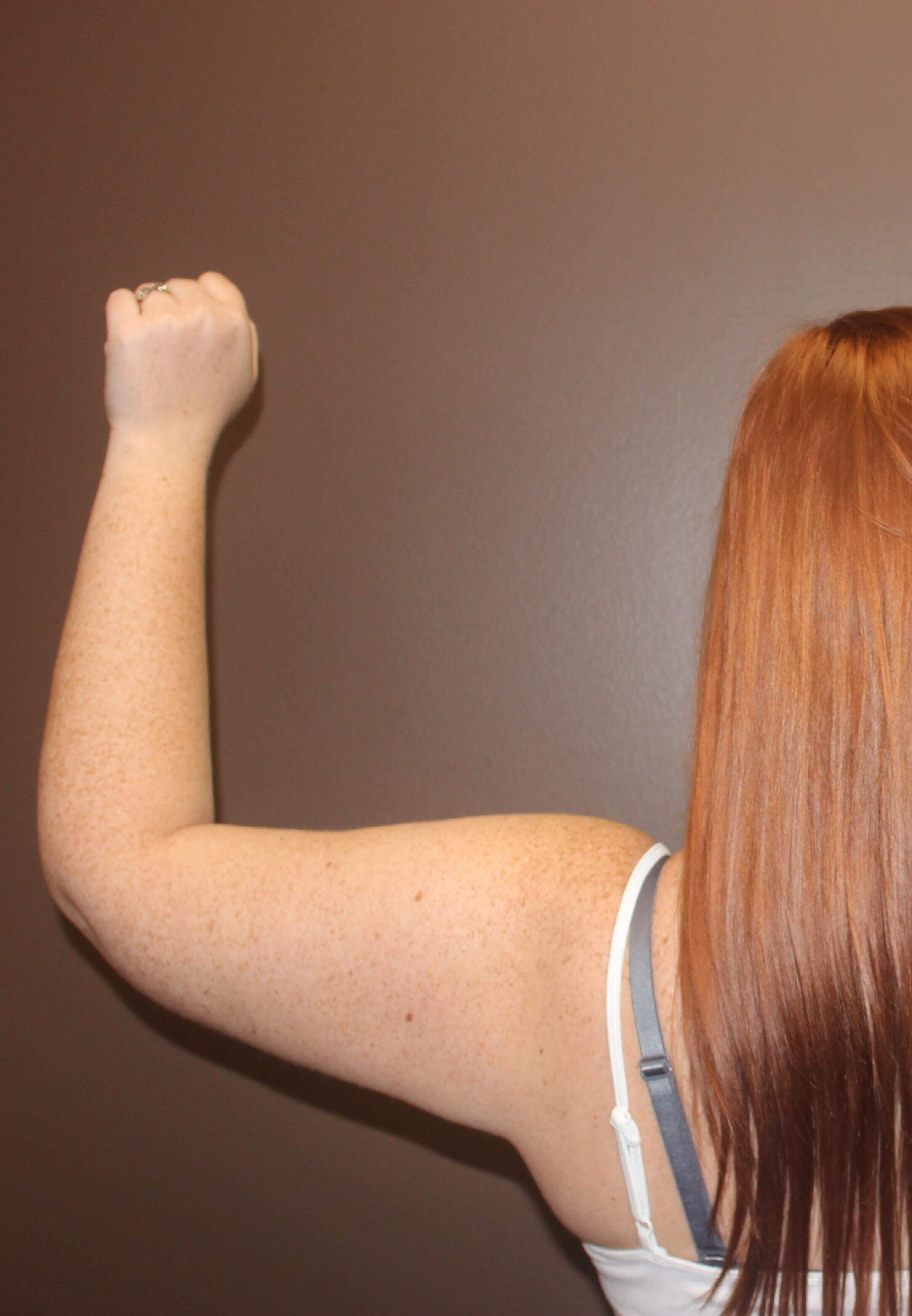Brachioplasty (Arm Lift) After