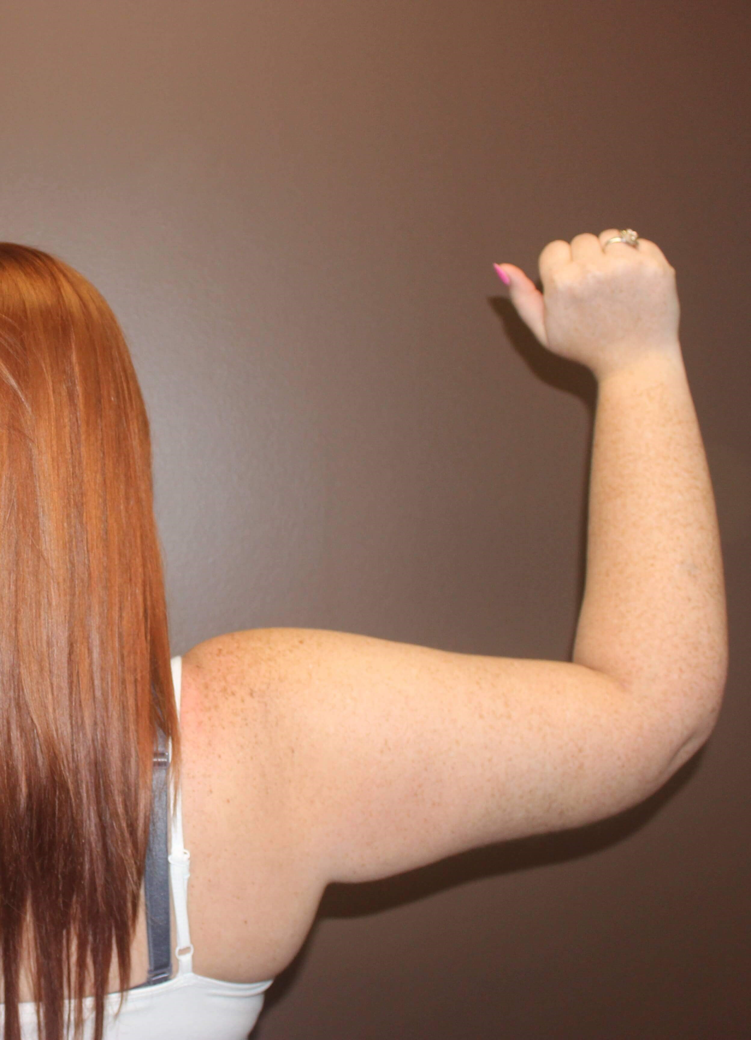 Brachioplasty (Arm Lift) After