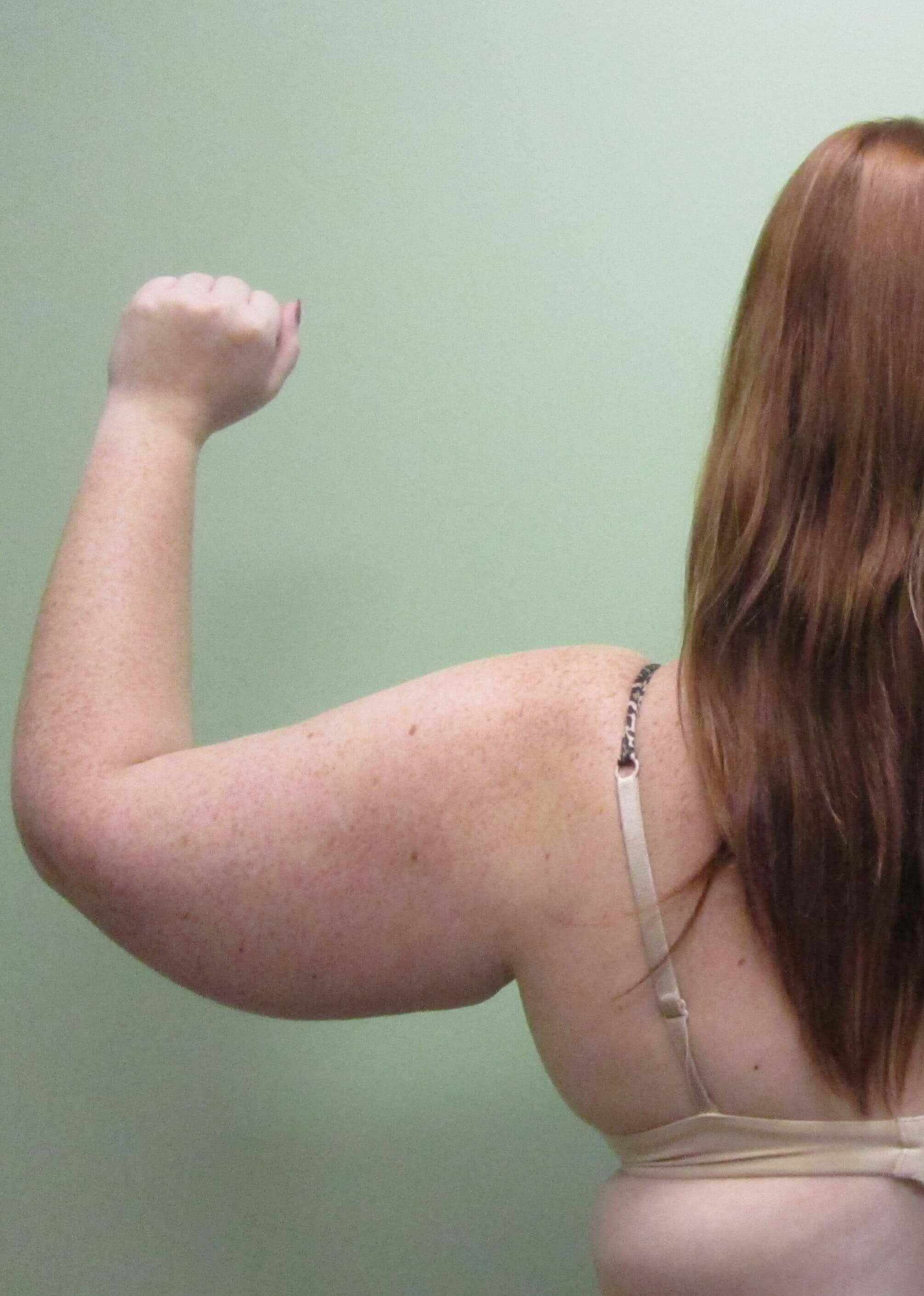 Brachioplasty (Arm Lift) Before