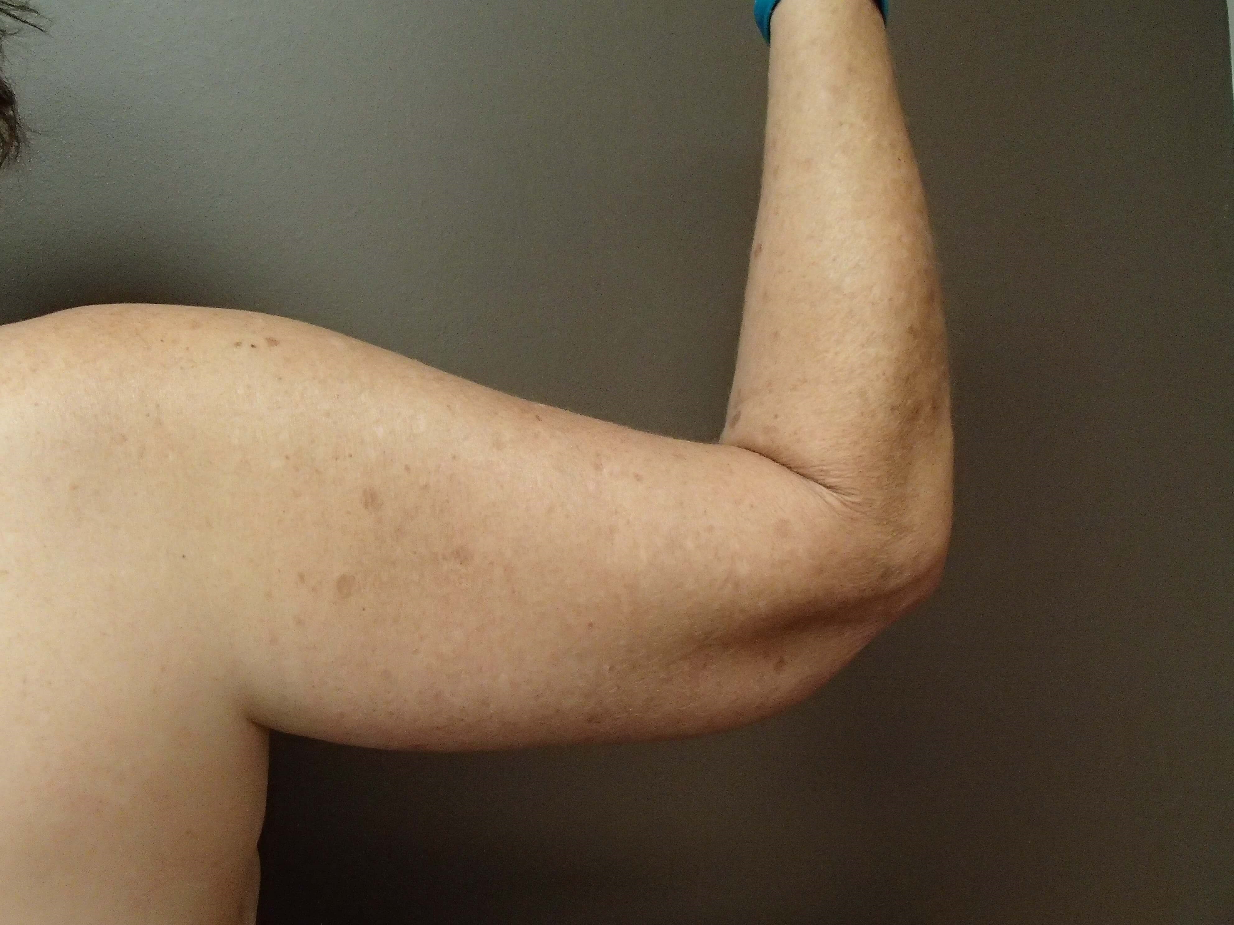 Brachioplasty (Arm Lift) After