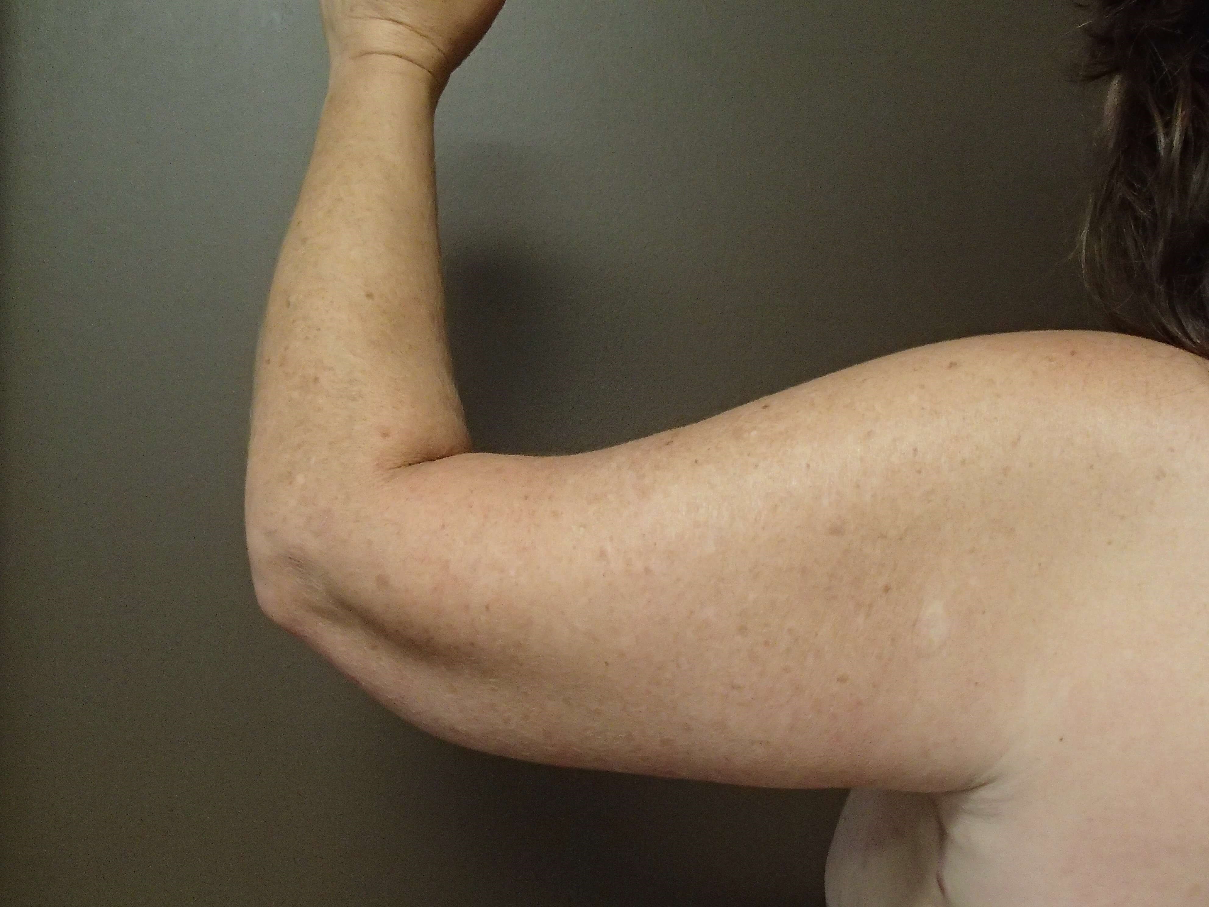 Brachioplasty (Arm Lift) After