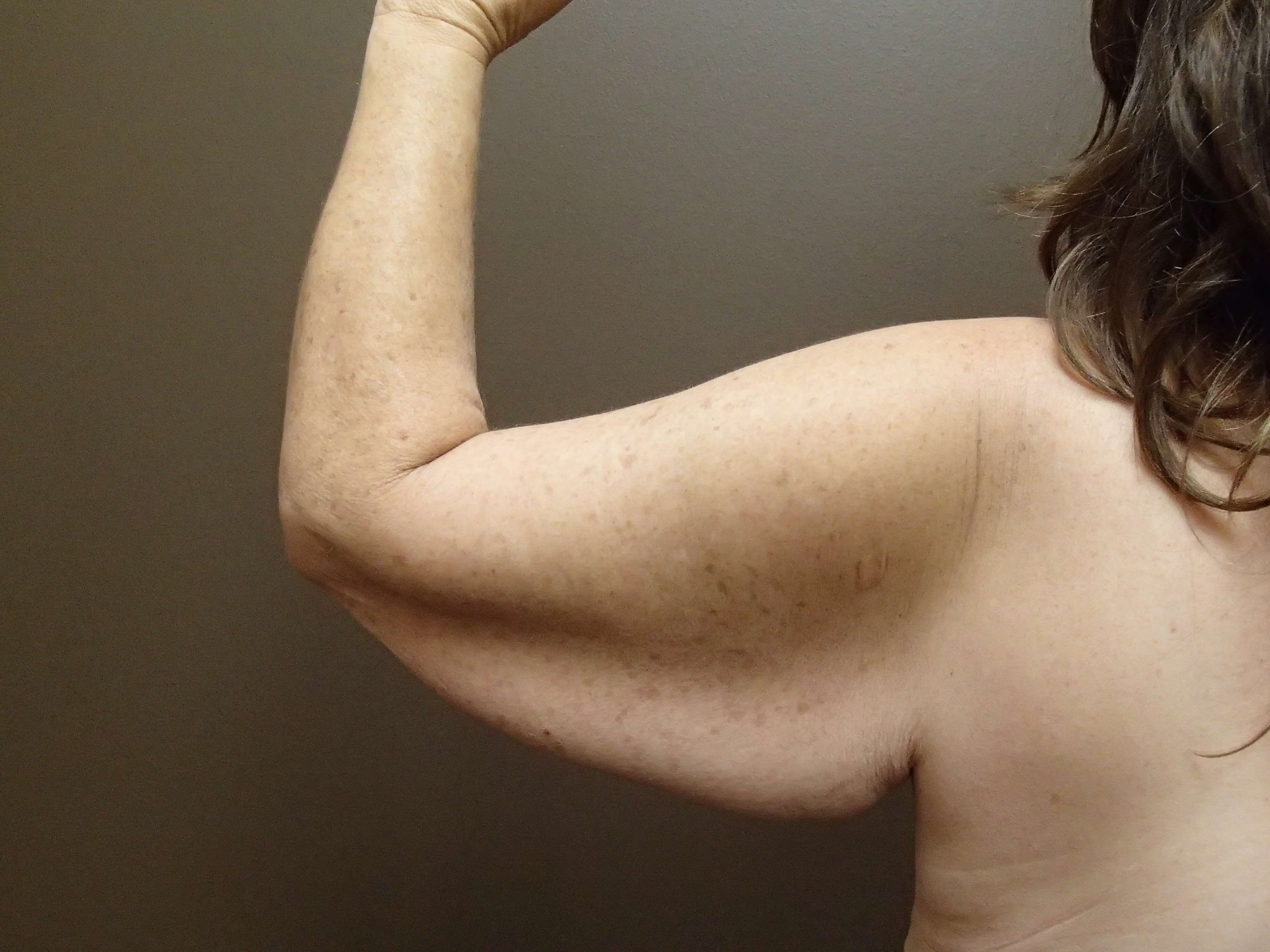 Brachioplasty (Arm Lift) Before