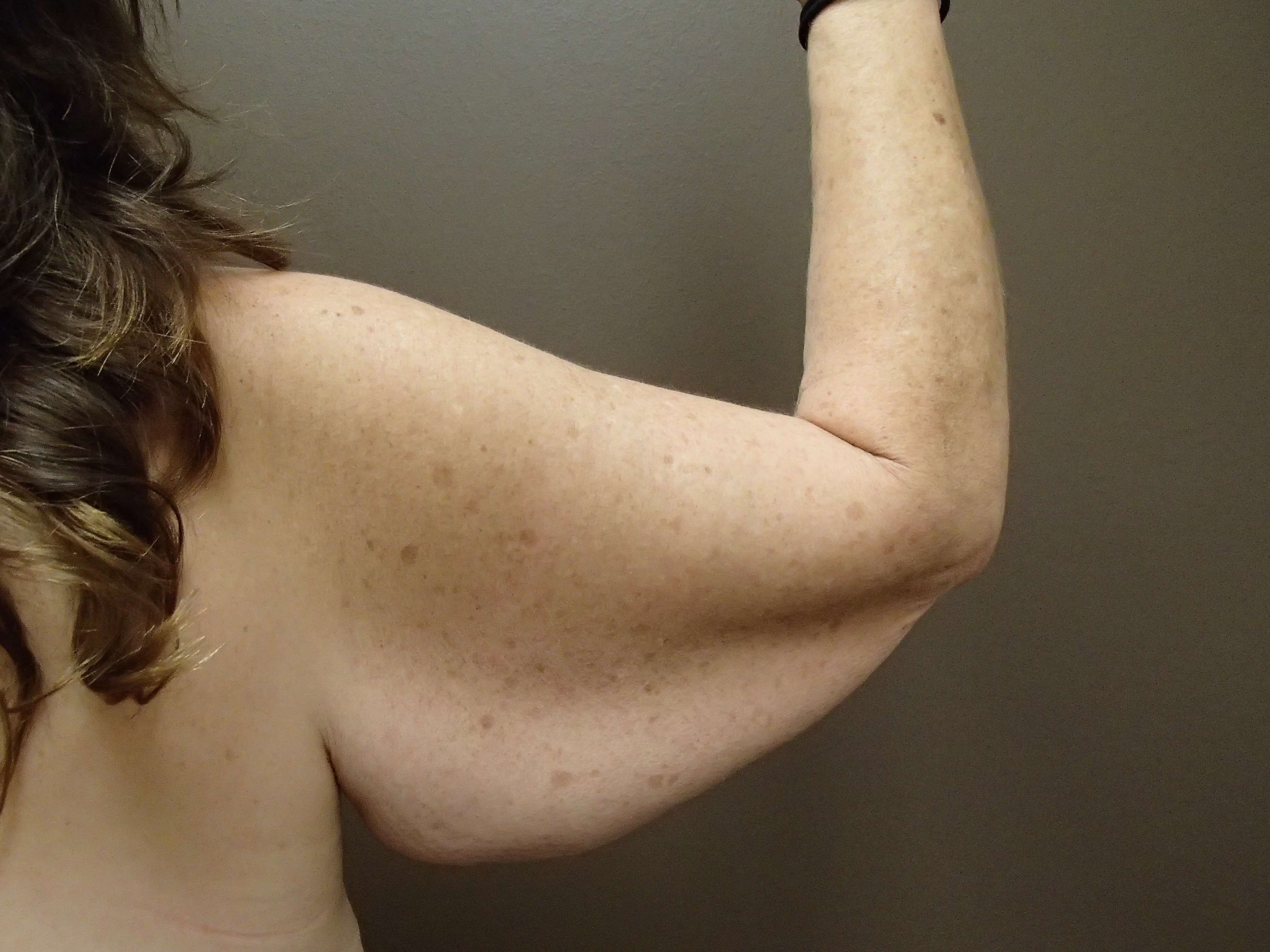 Brachioplasty (Arm Lift) Before