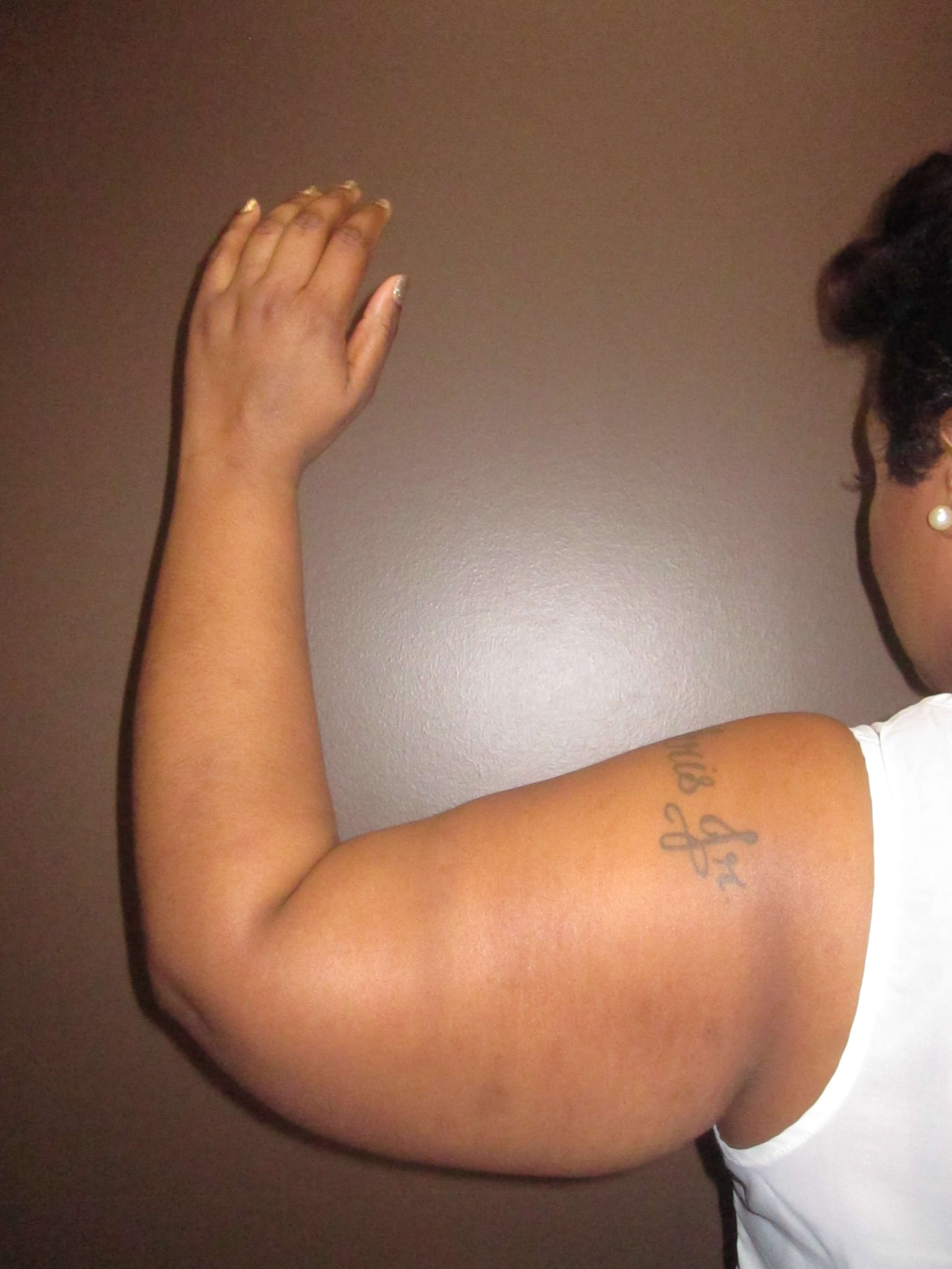 Brachioplasty (Arm Lift) Before