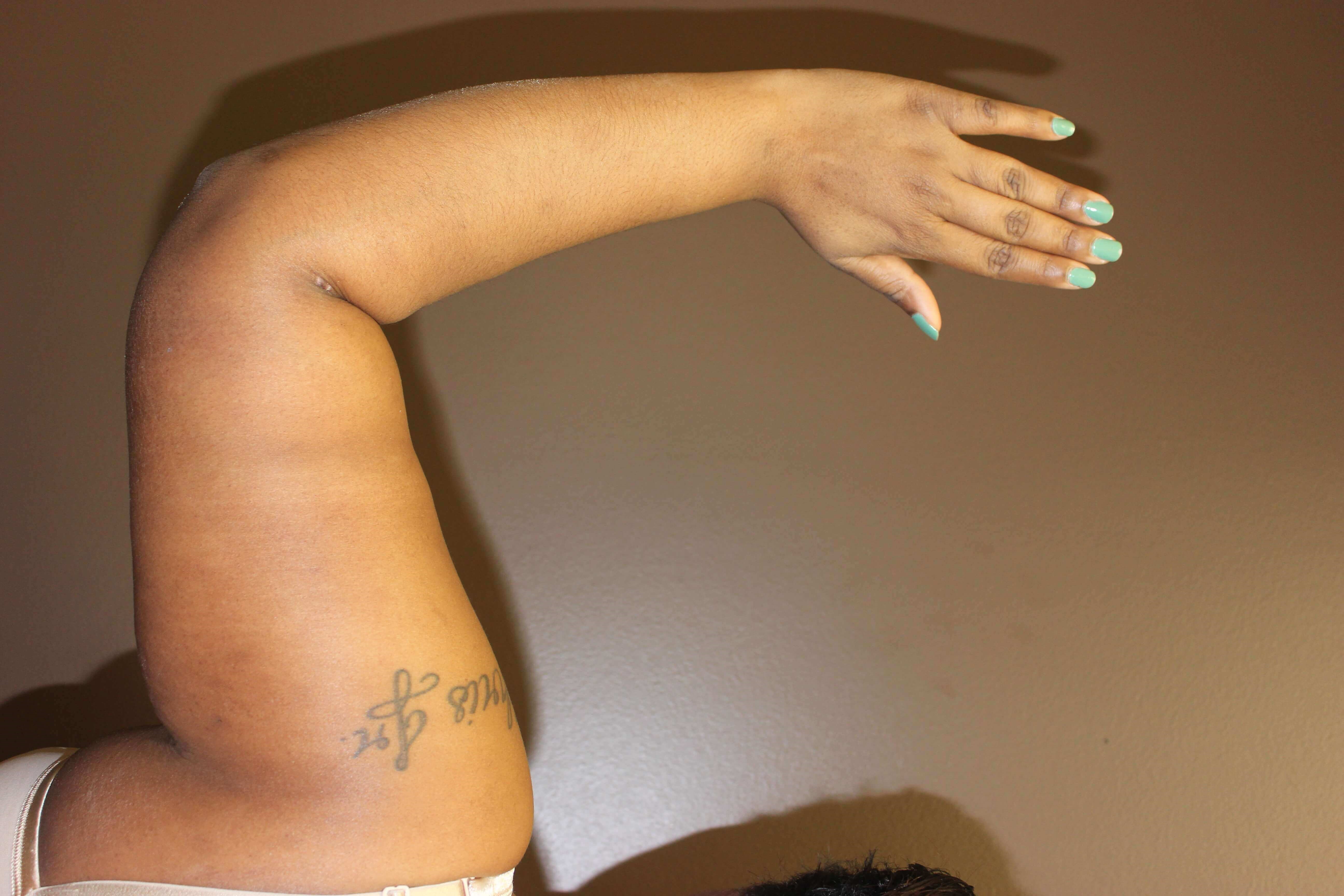 Brachioplasty (Arm Lift) After