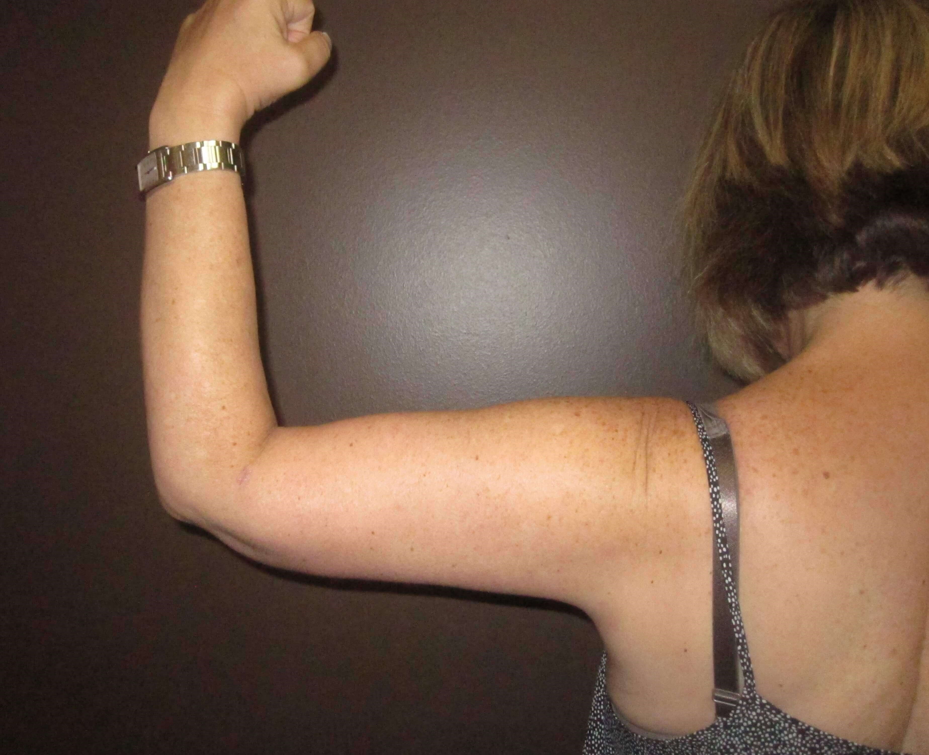 Brachioplasty (Arm Lift) After