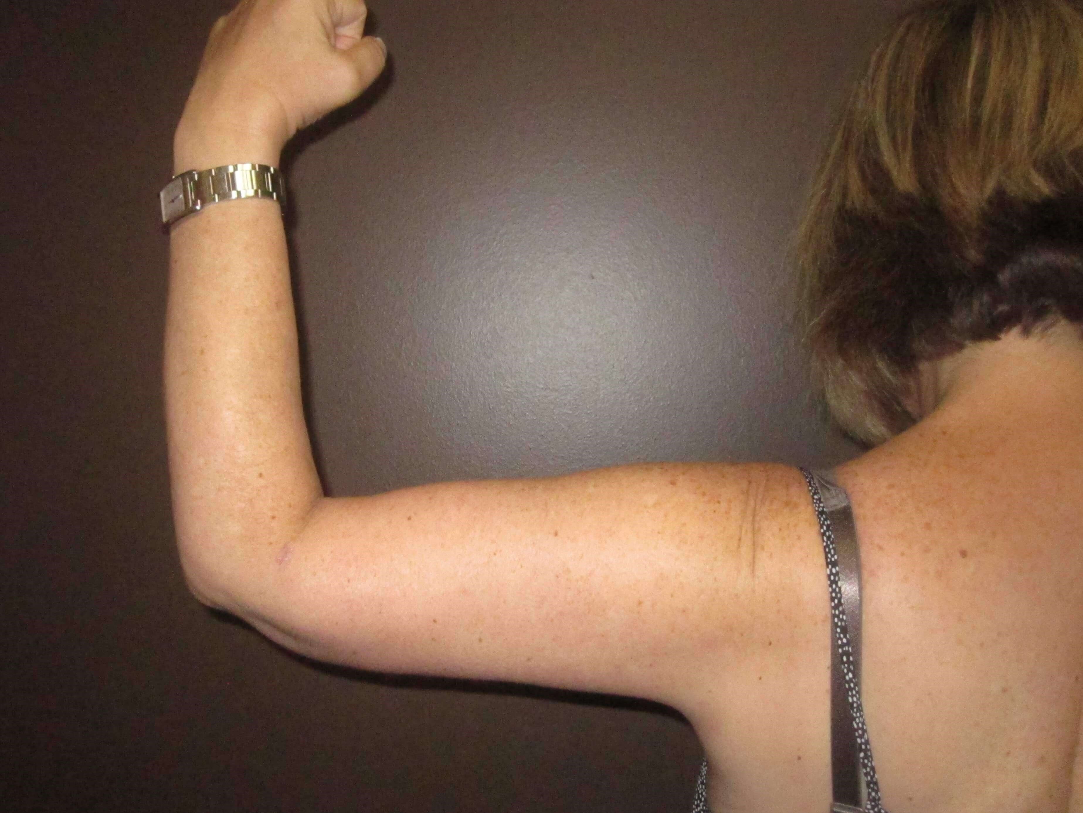 Brachioplasty (Arm Lift) After