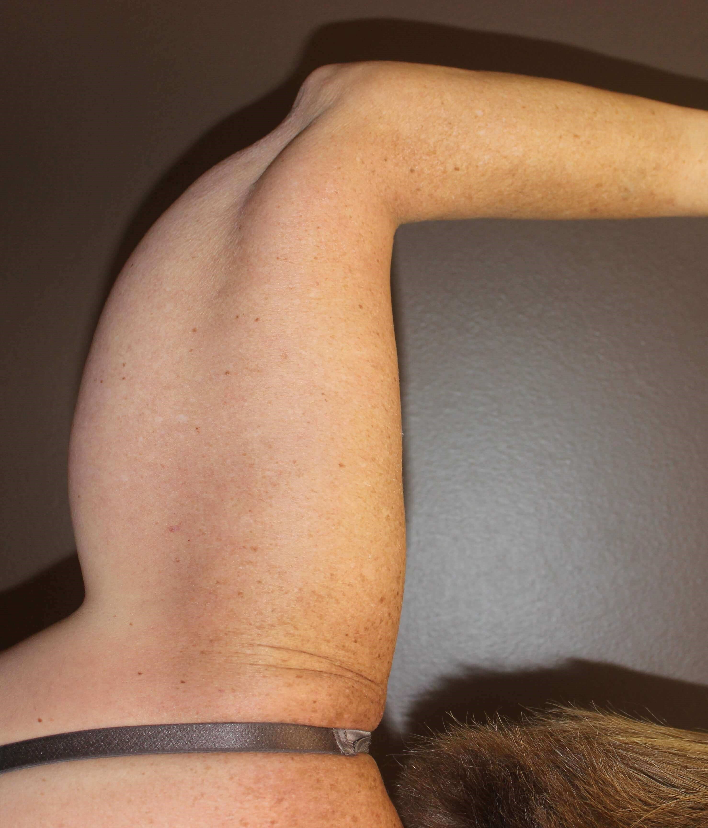 Brachioplasty (Arm Lift) Before
