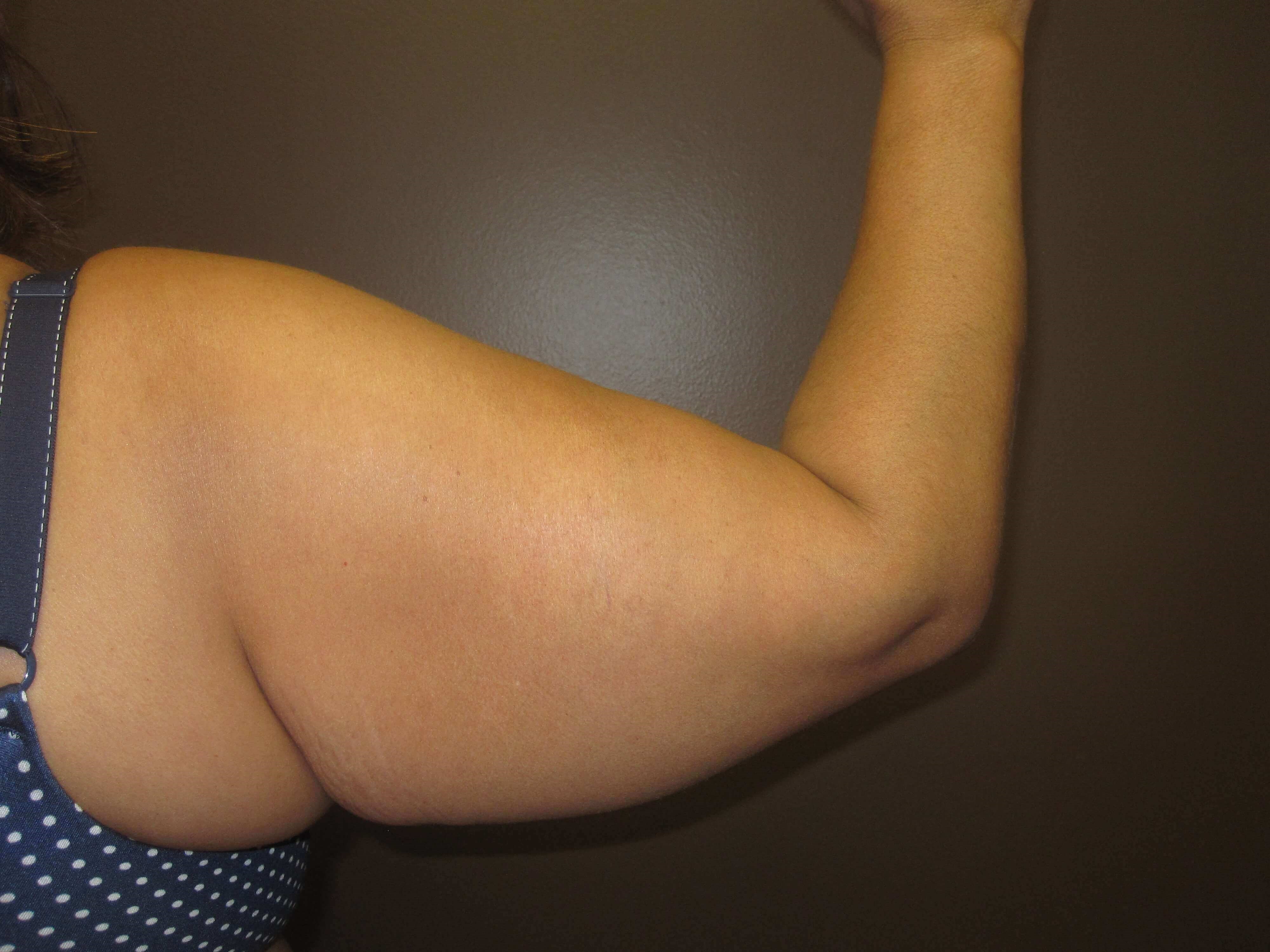 Brachioplasty (Arm Lift) Before