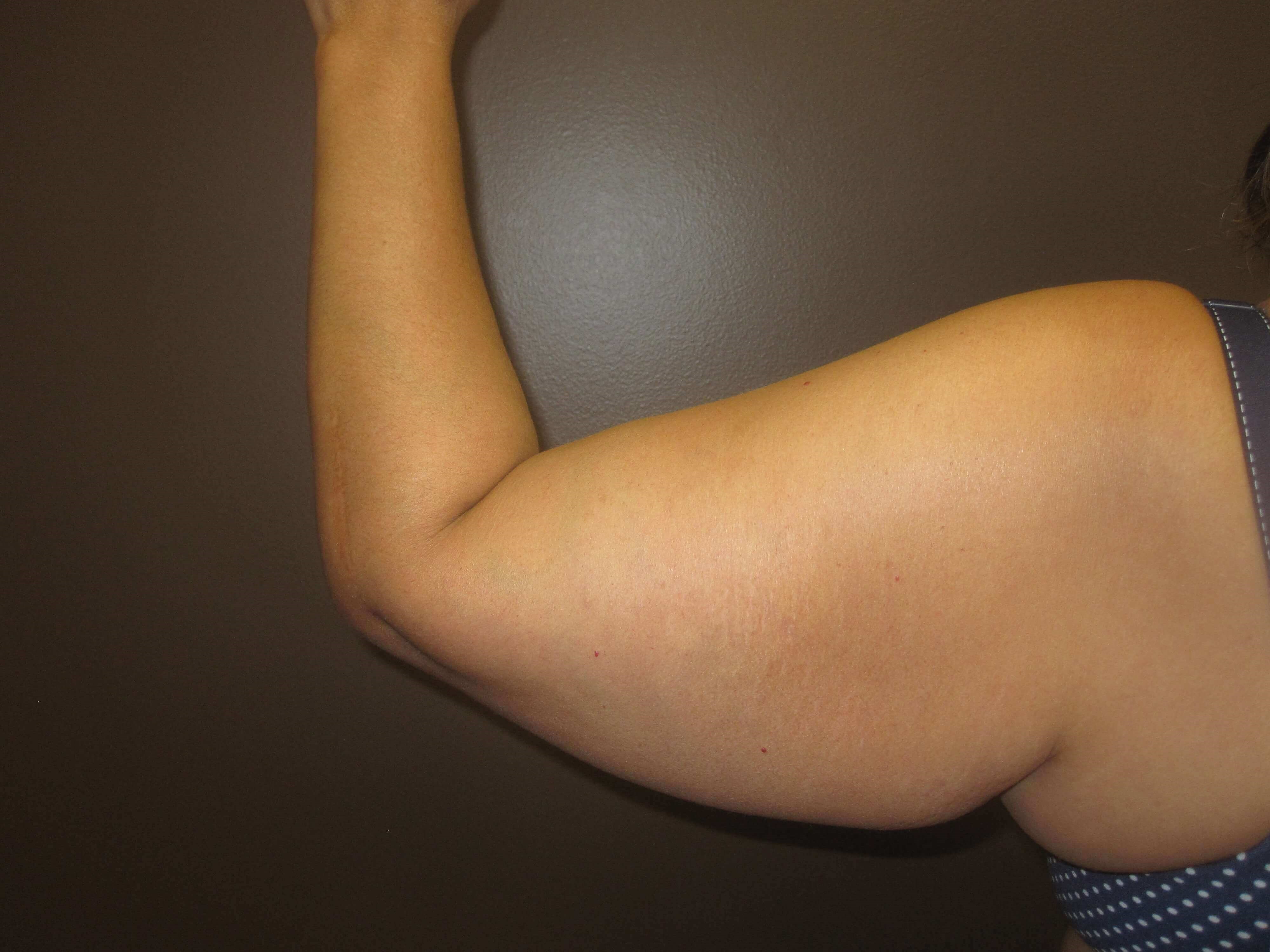 Brachioplasty (Arm Lift) Before