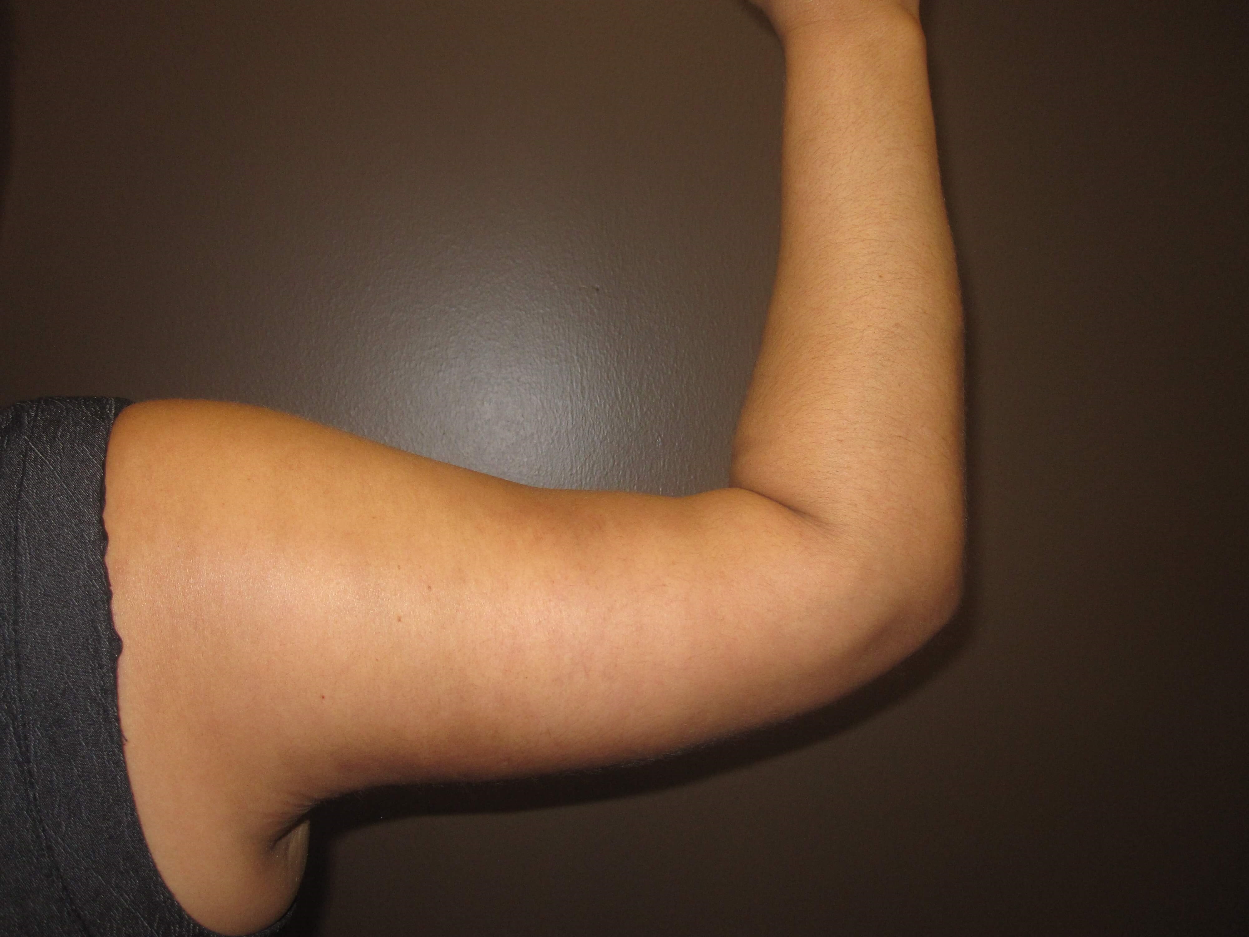 Brachioplasty (Arm Lift) After