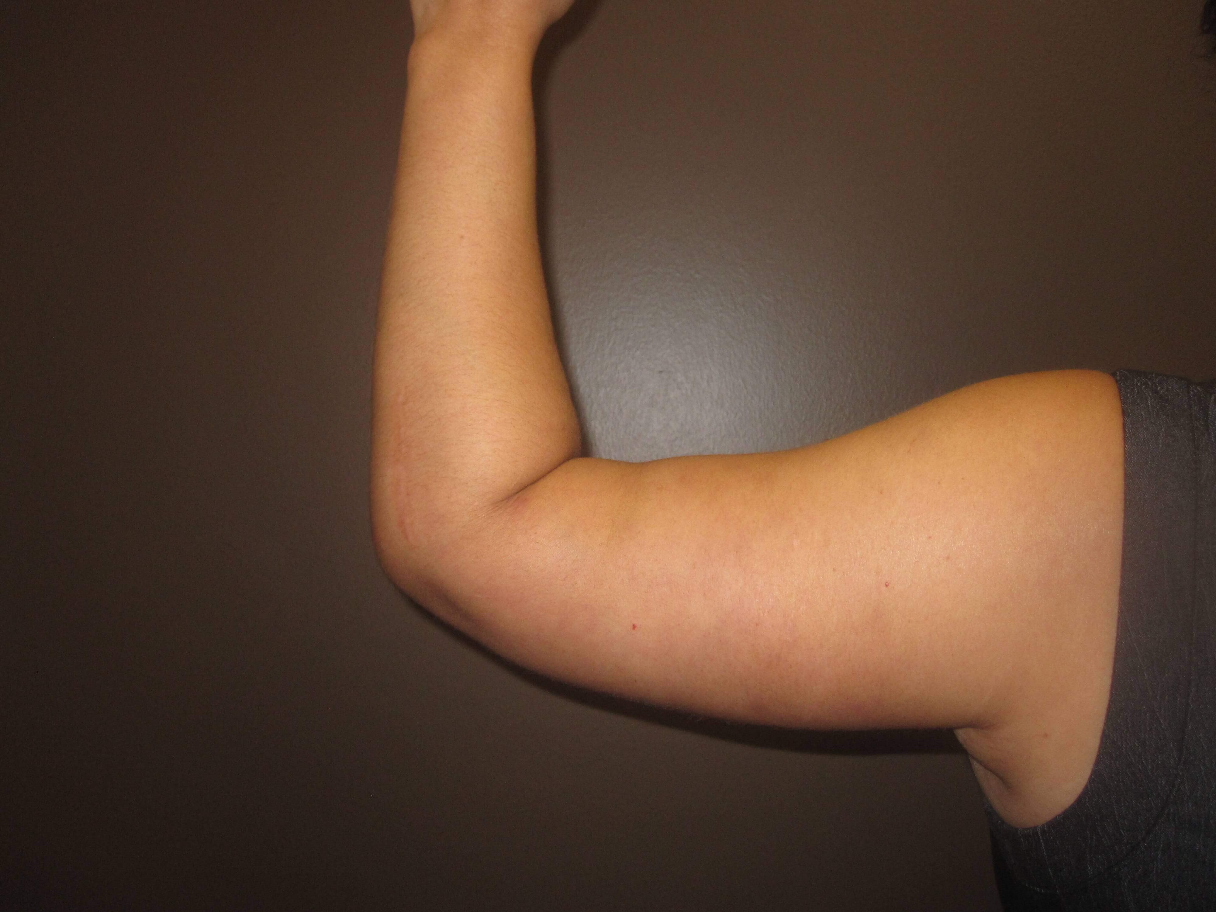 Brachioplasty (Arm Lift) After