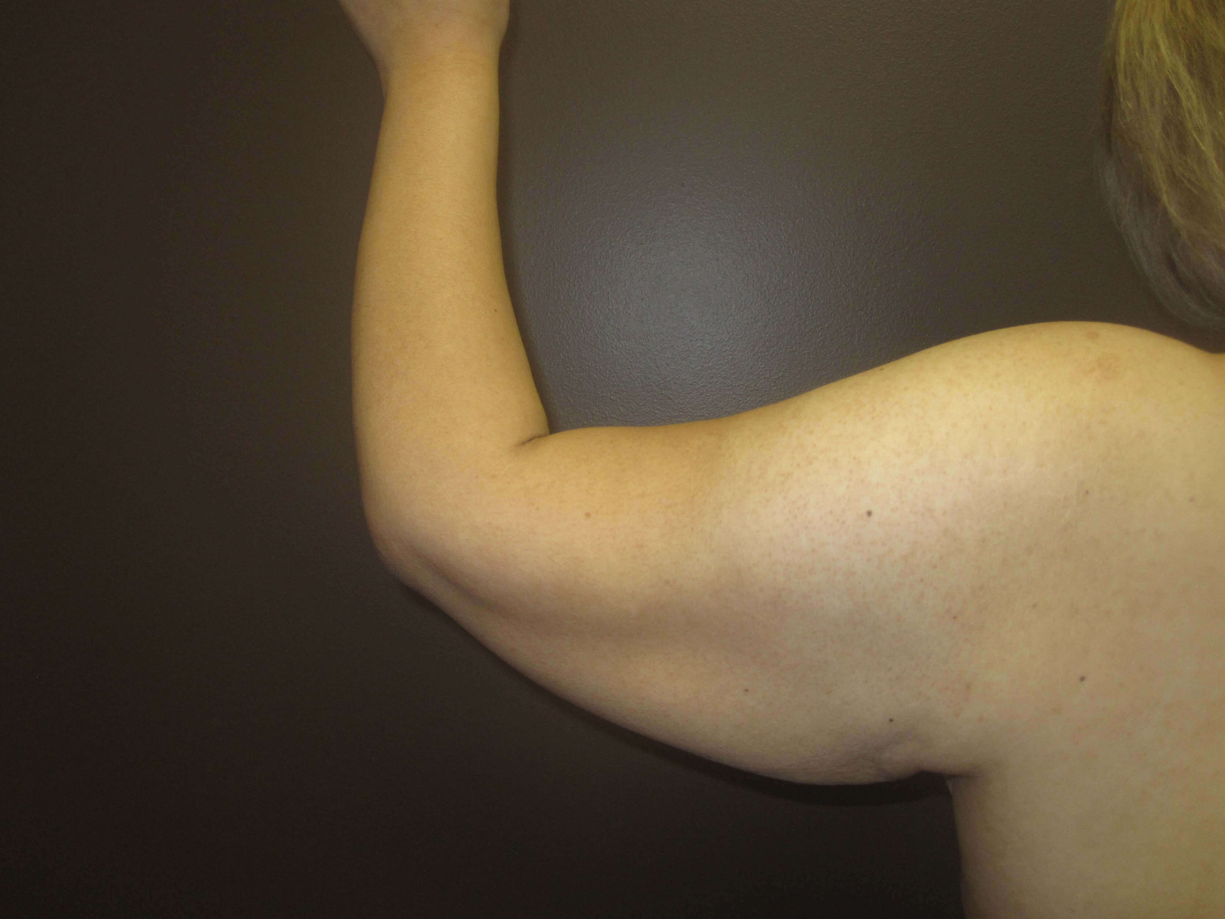 Brachioplasty (Arm Lift) Before