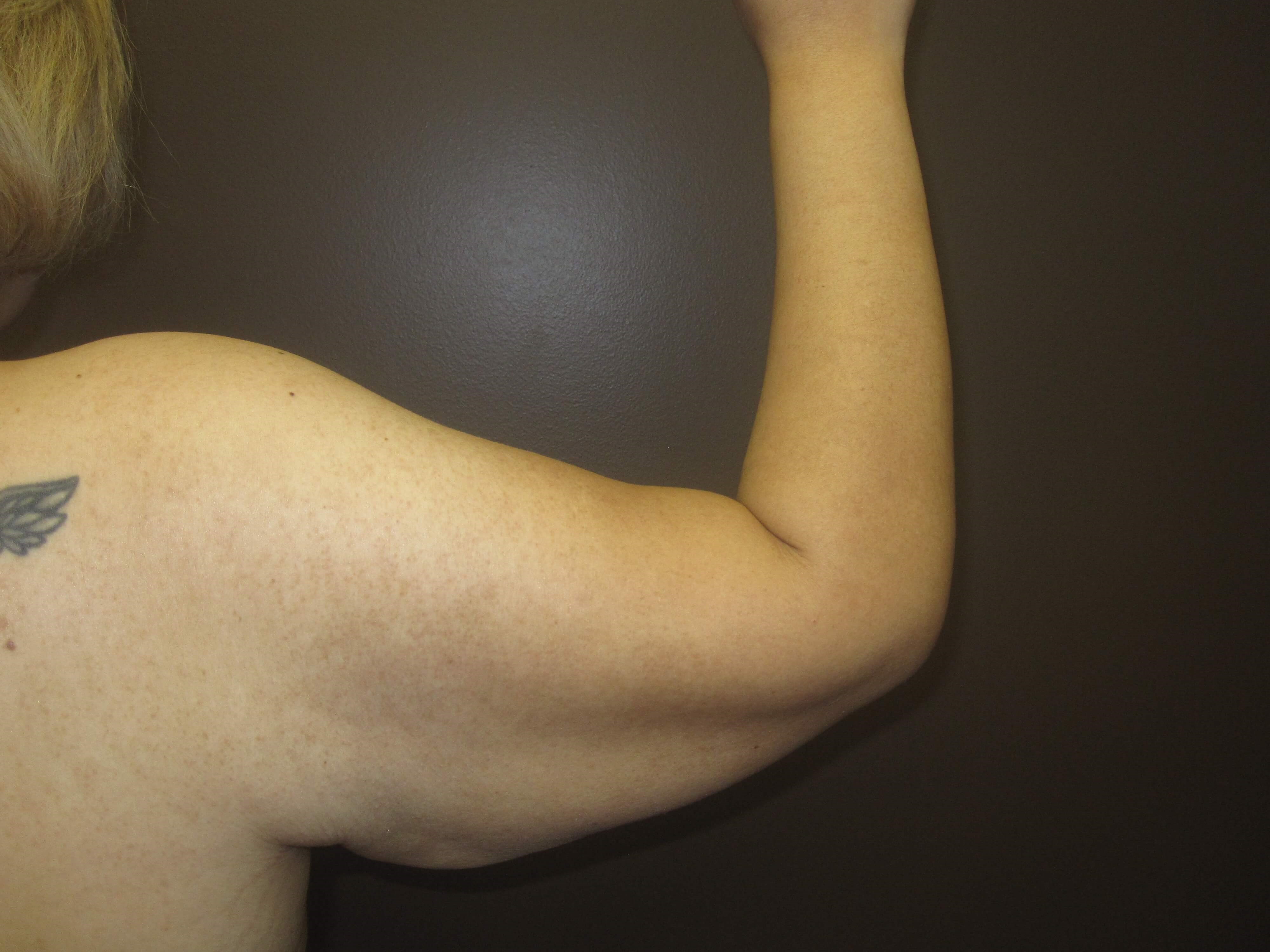 Brachioplasty (Arm Lift) Before