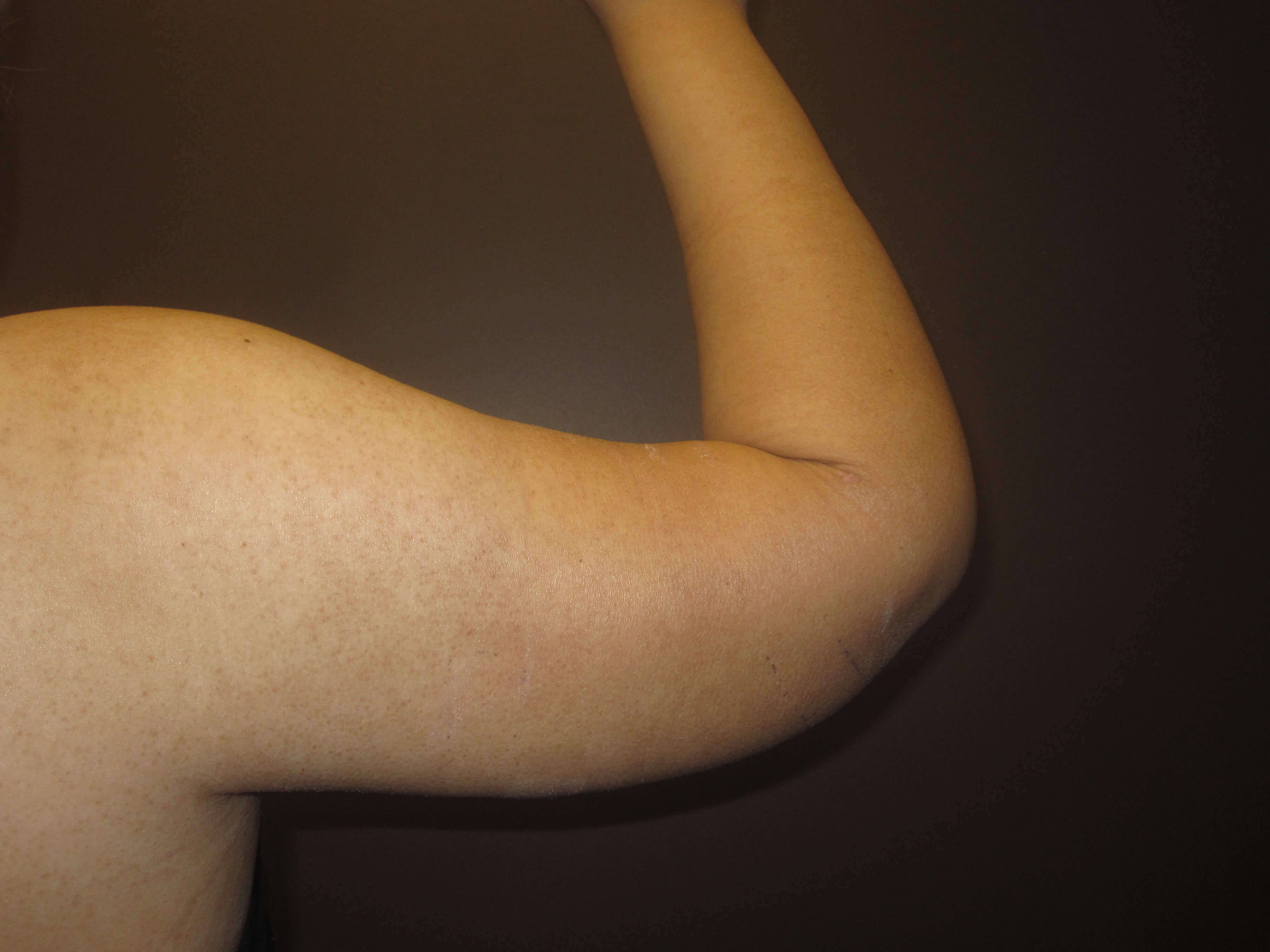Brachioplasty (Arm Lift) After
