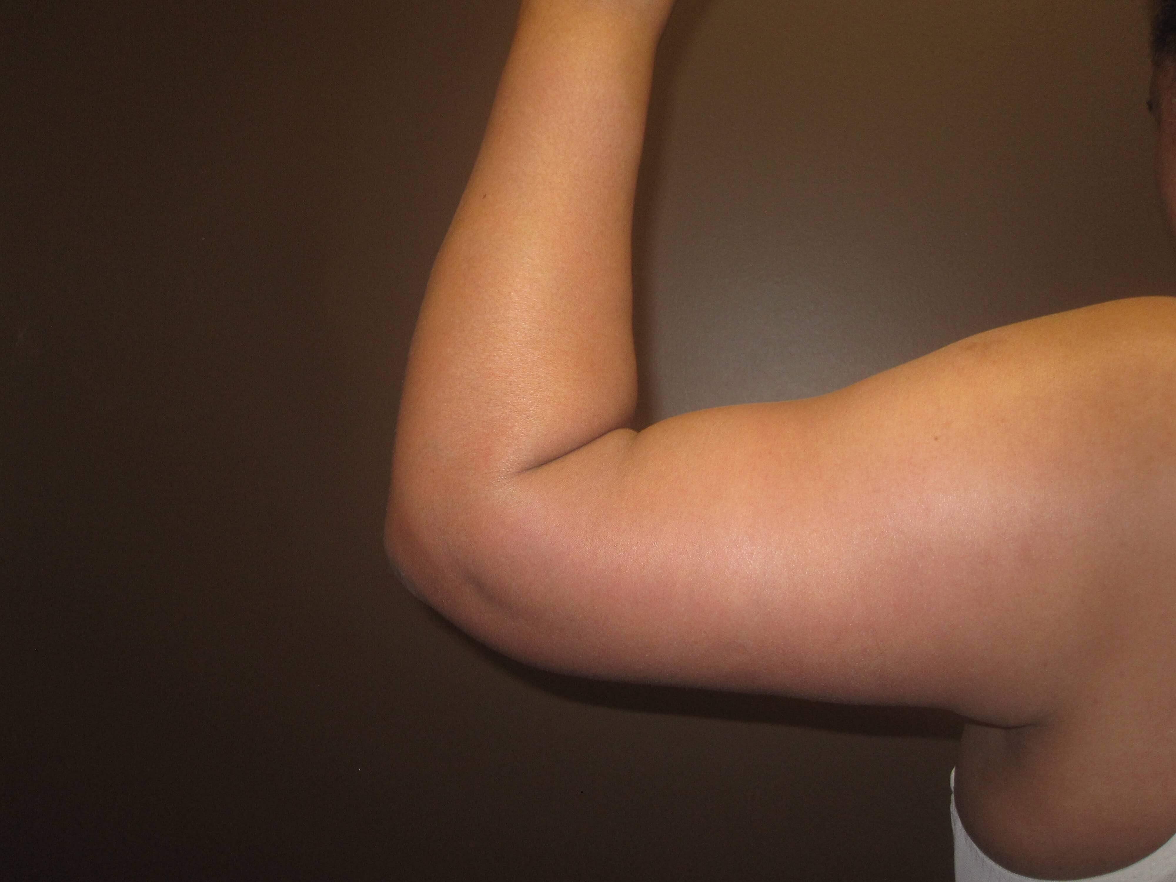 Brachioplasty (Arm Lift) After