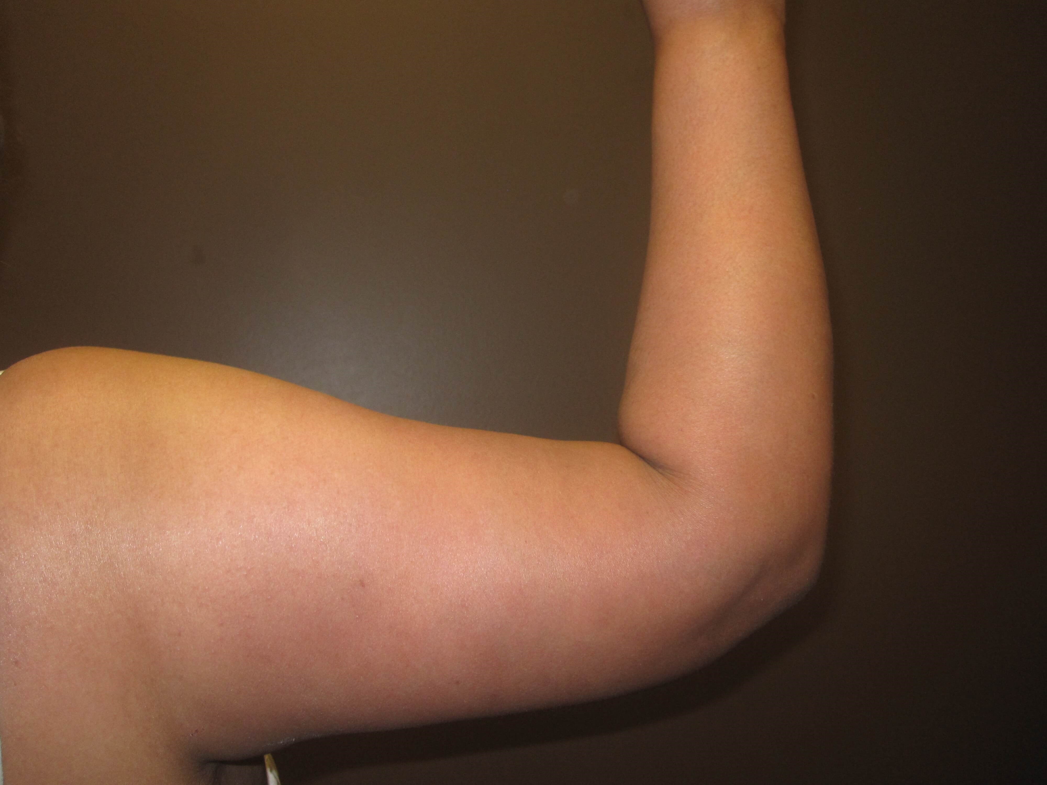 Brachioplasty (Arm Lift) After