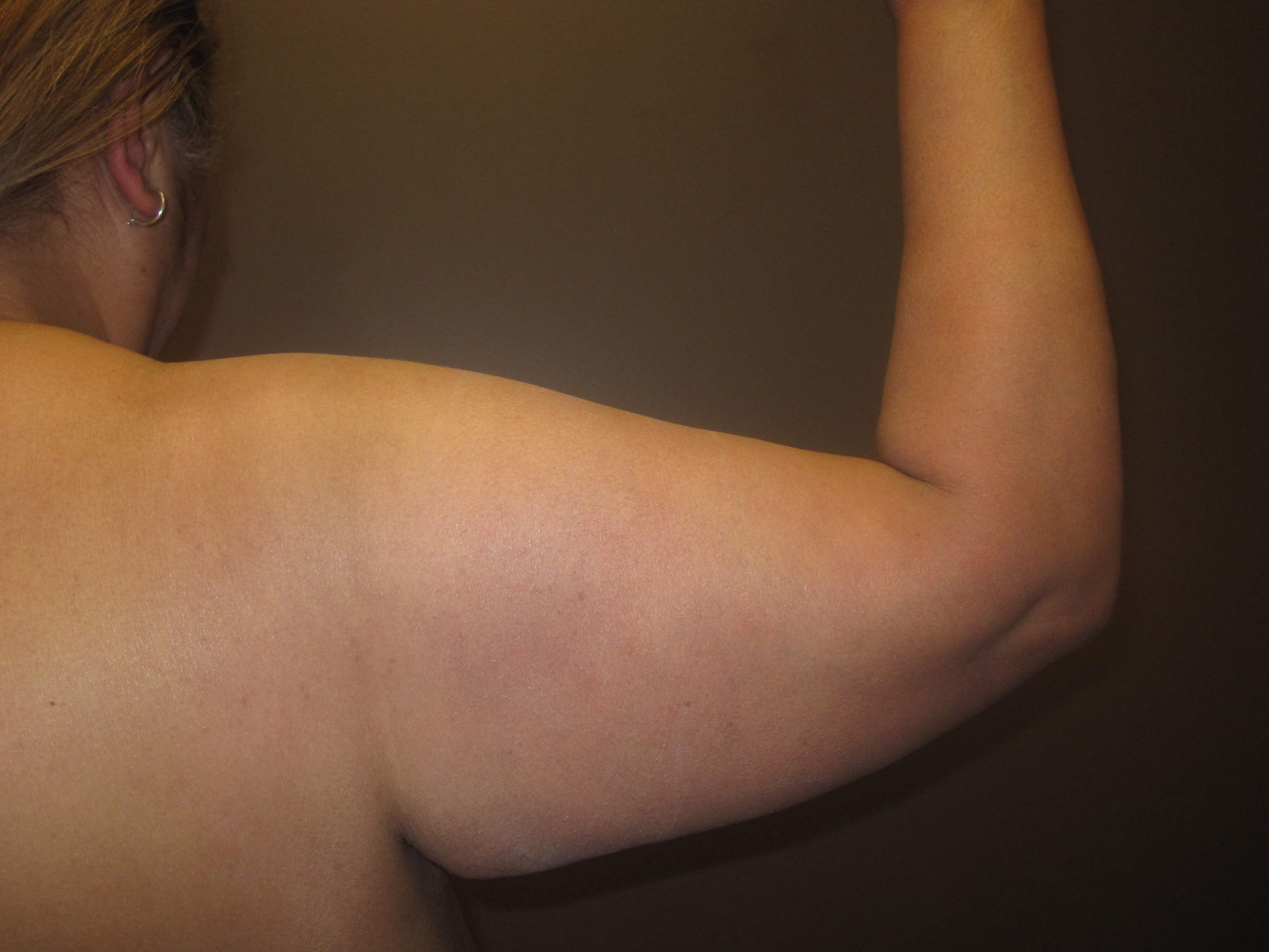 Brachioplasty (Arm Lift) Before