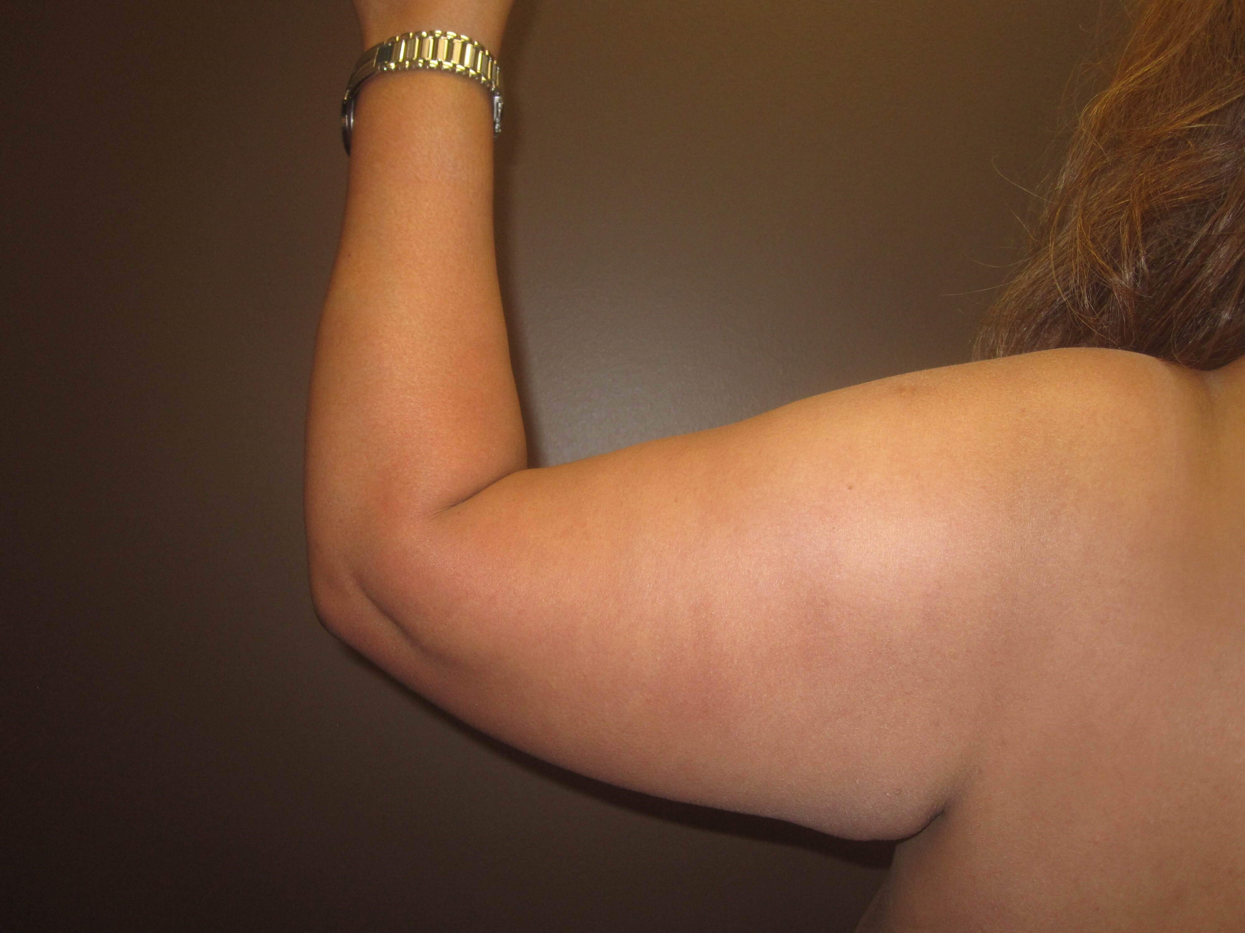 Brachioplasty (Arm Lift) Before