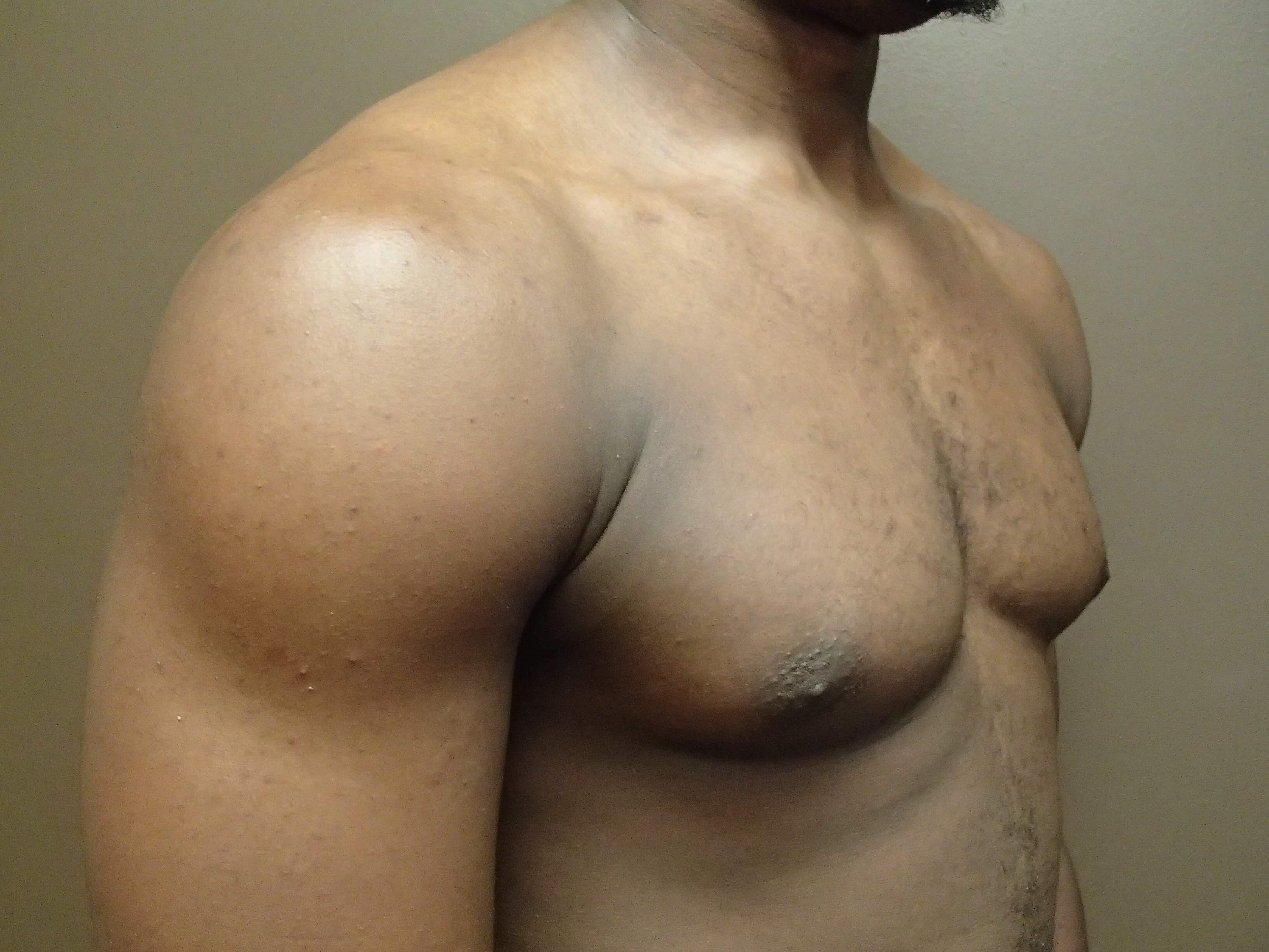 Gynecomastia (male breast redu Before