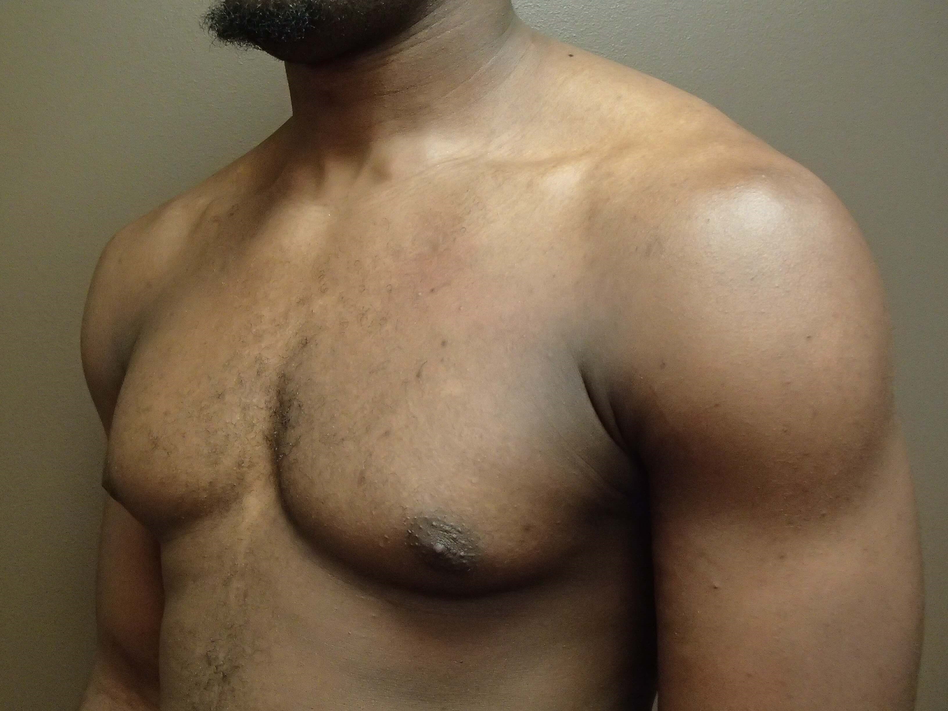 Gynecomastia (male breast redu Before