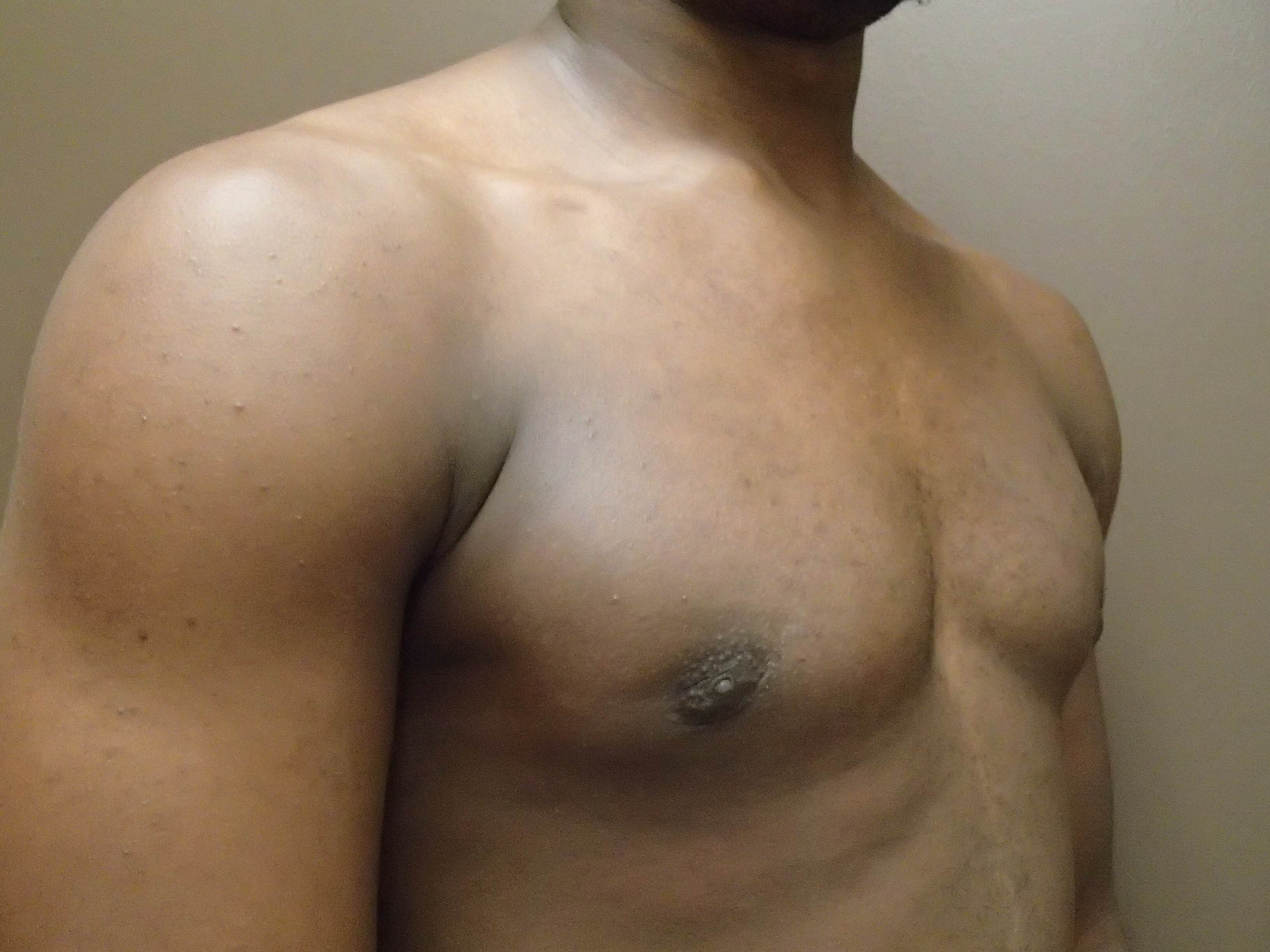 Gynecomastia (male breast redu After