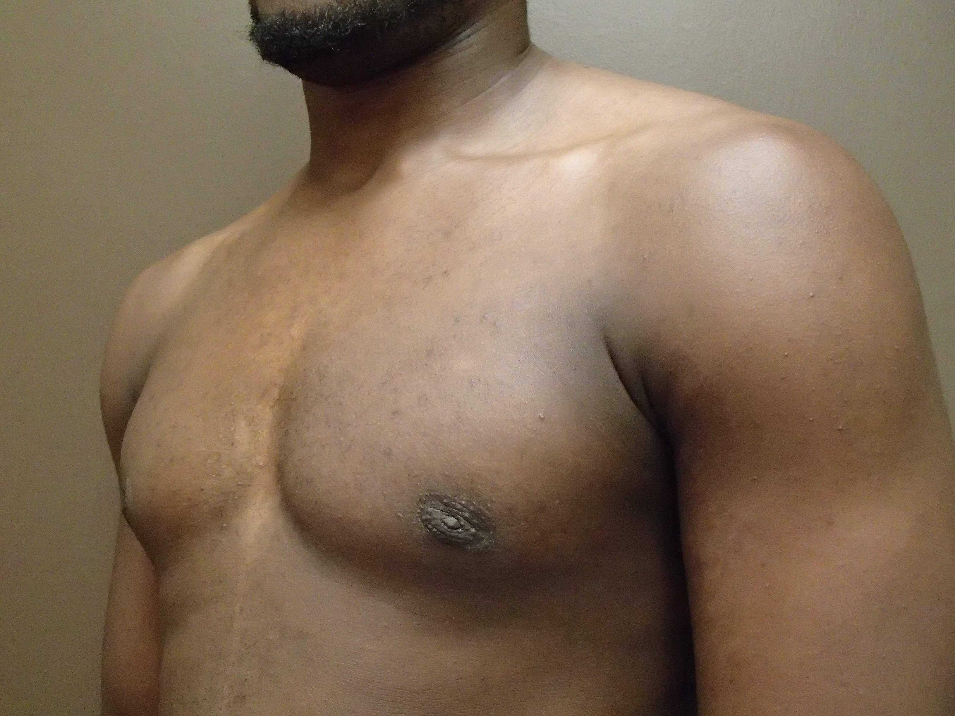 Gynecomastia (male breast redu After