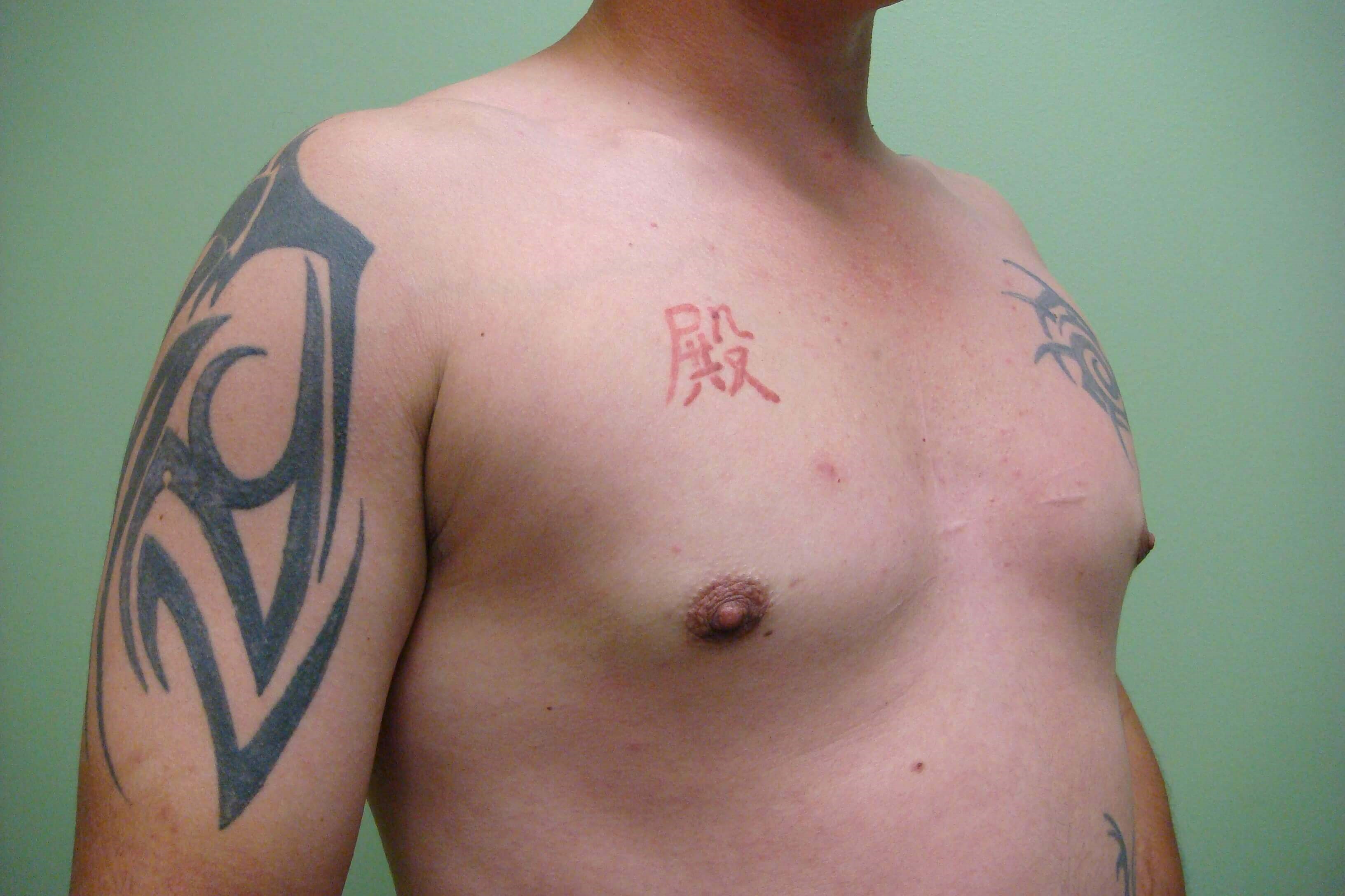 Gynecomastia (male breast redu After