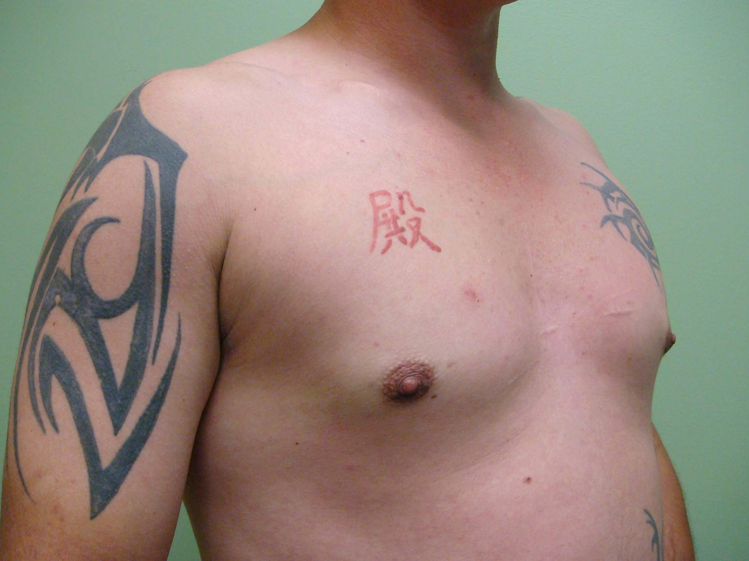 Gynecomastia (male breast redu After