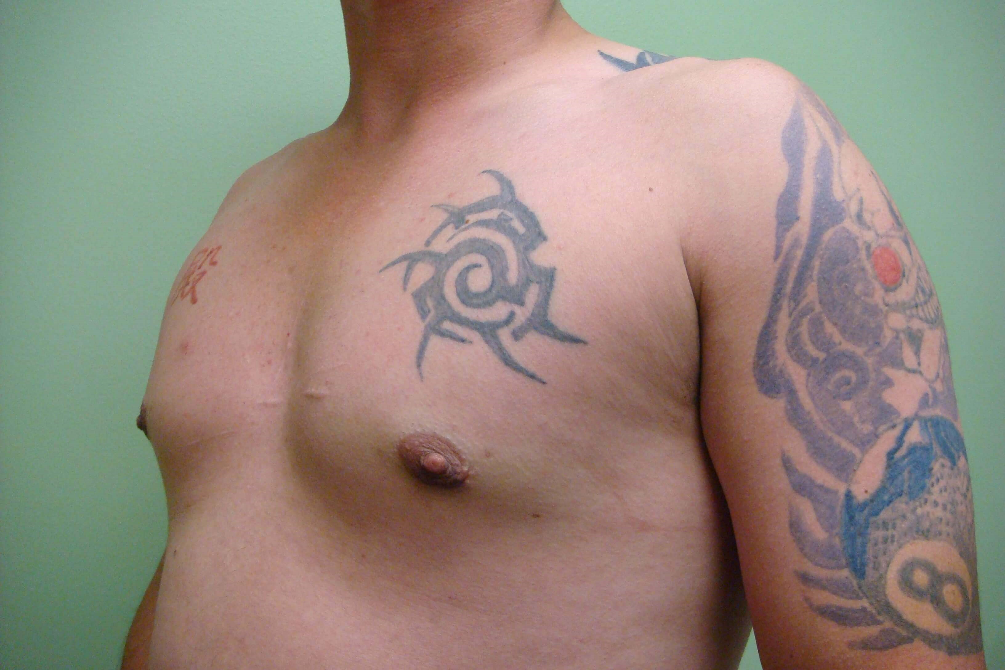 Gynecomastia (male breast redu After