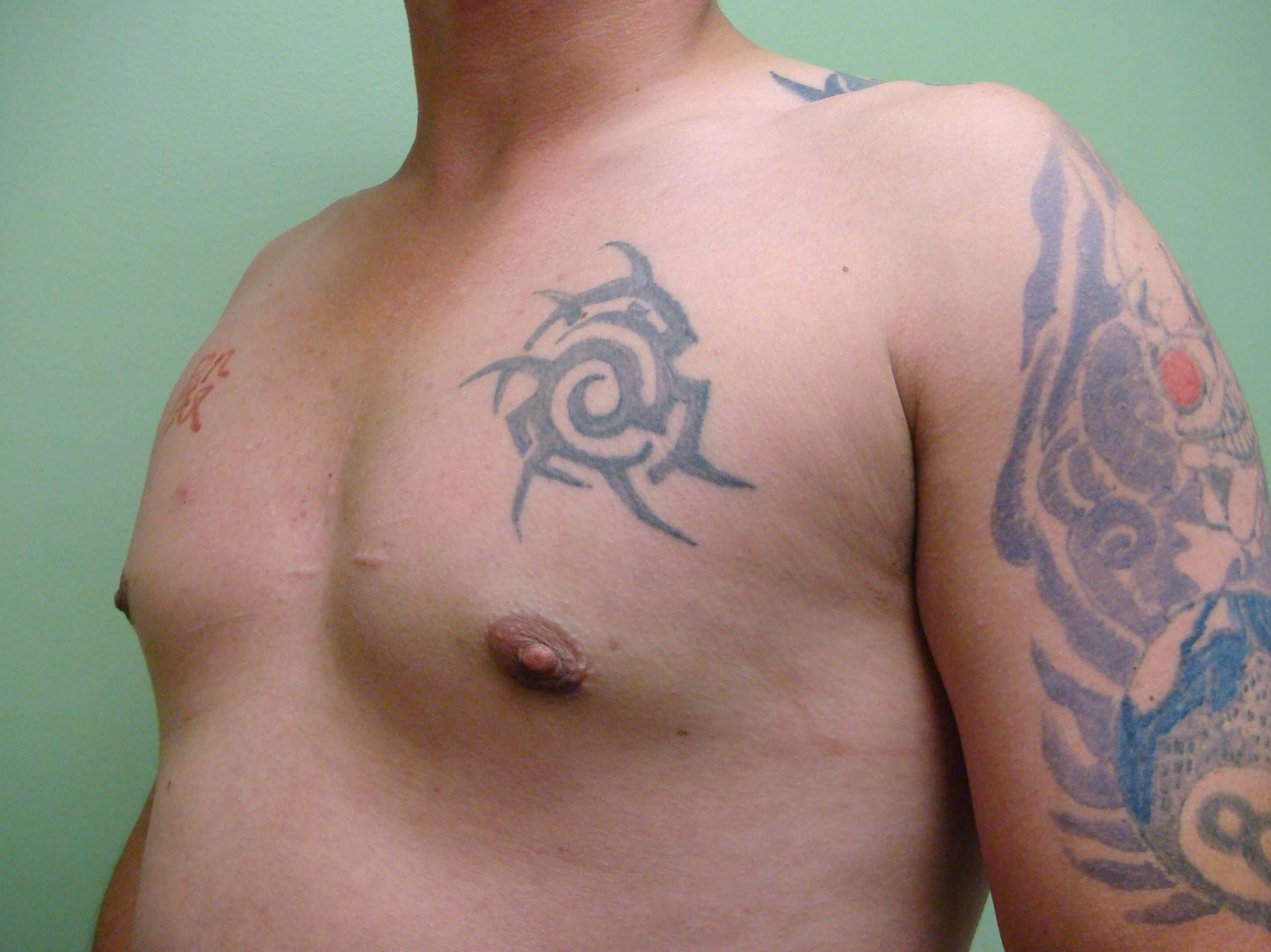 Gynecomastia (male breast redu After