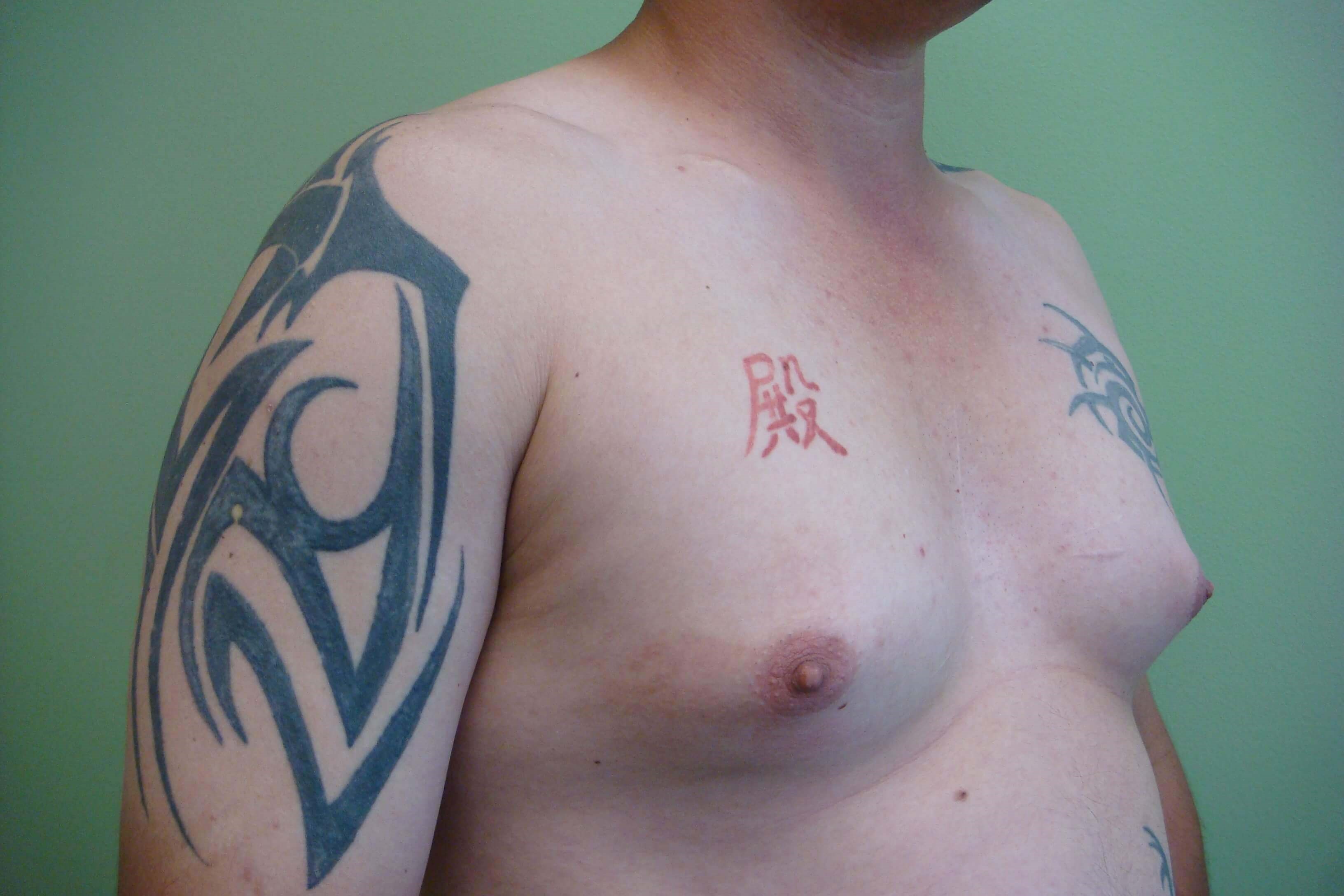 Gynecomastia (male breast redu Before