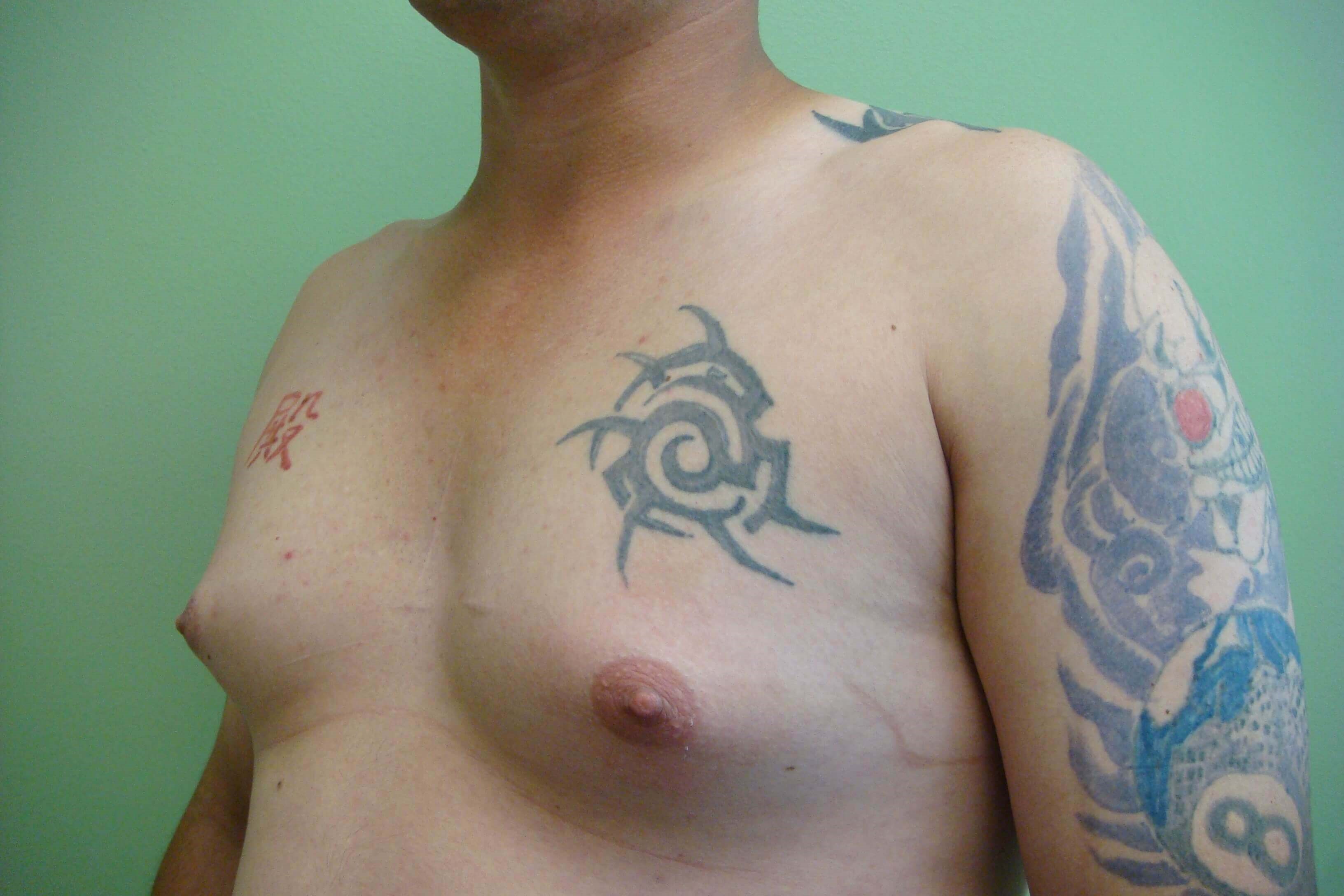 Gynecomastia (male breast redu Before