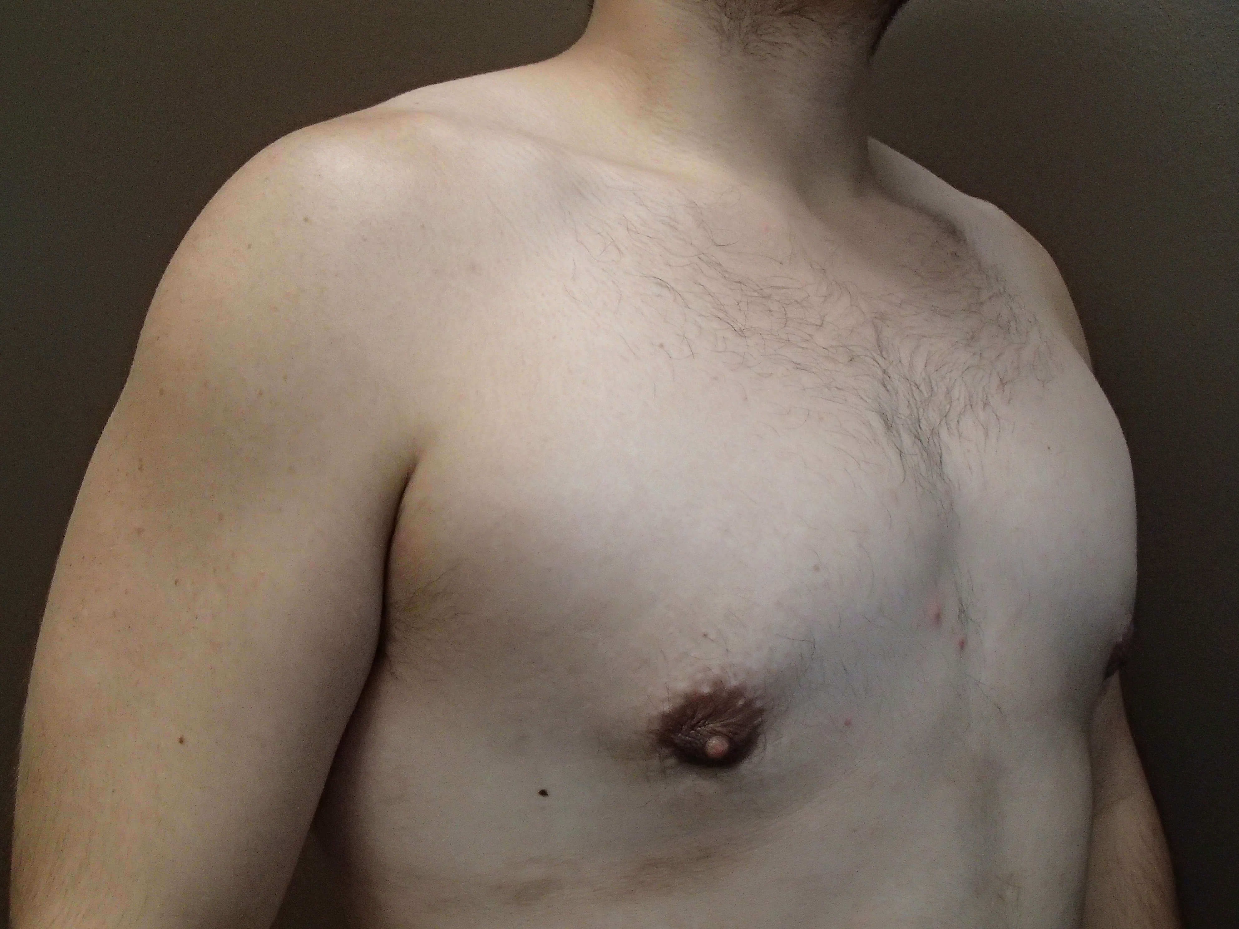 Gynecomastia (male breast redu After