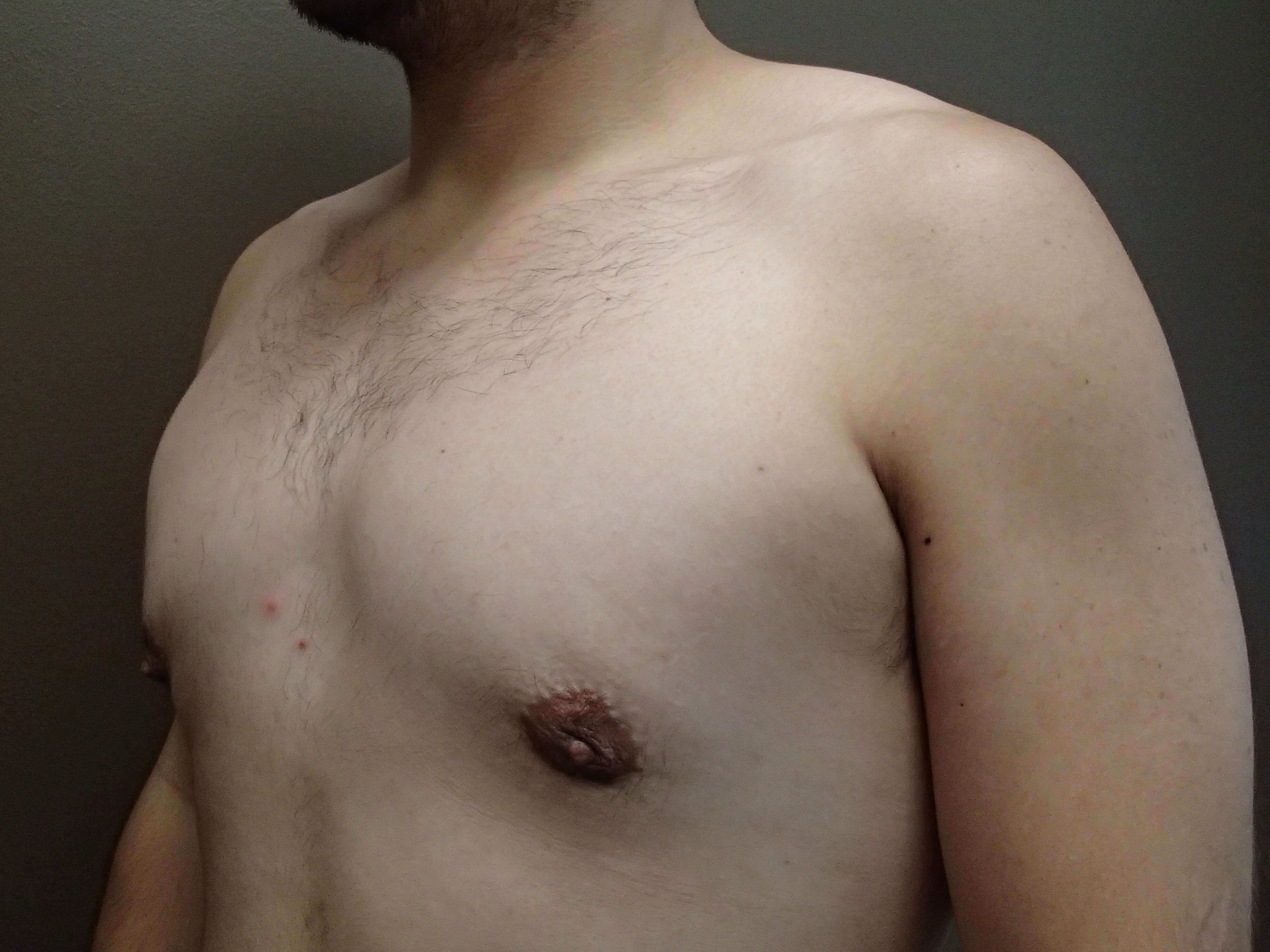 Gynecomastia (male breast redu After