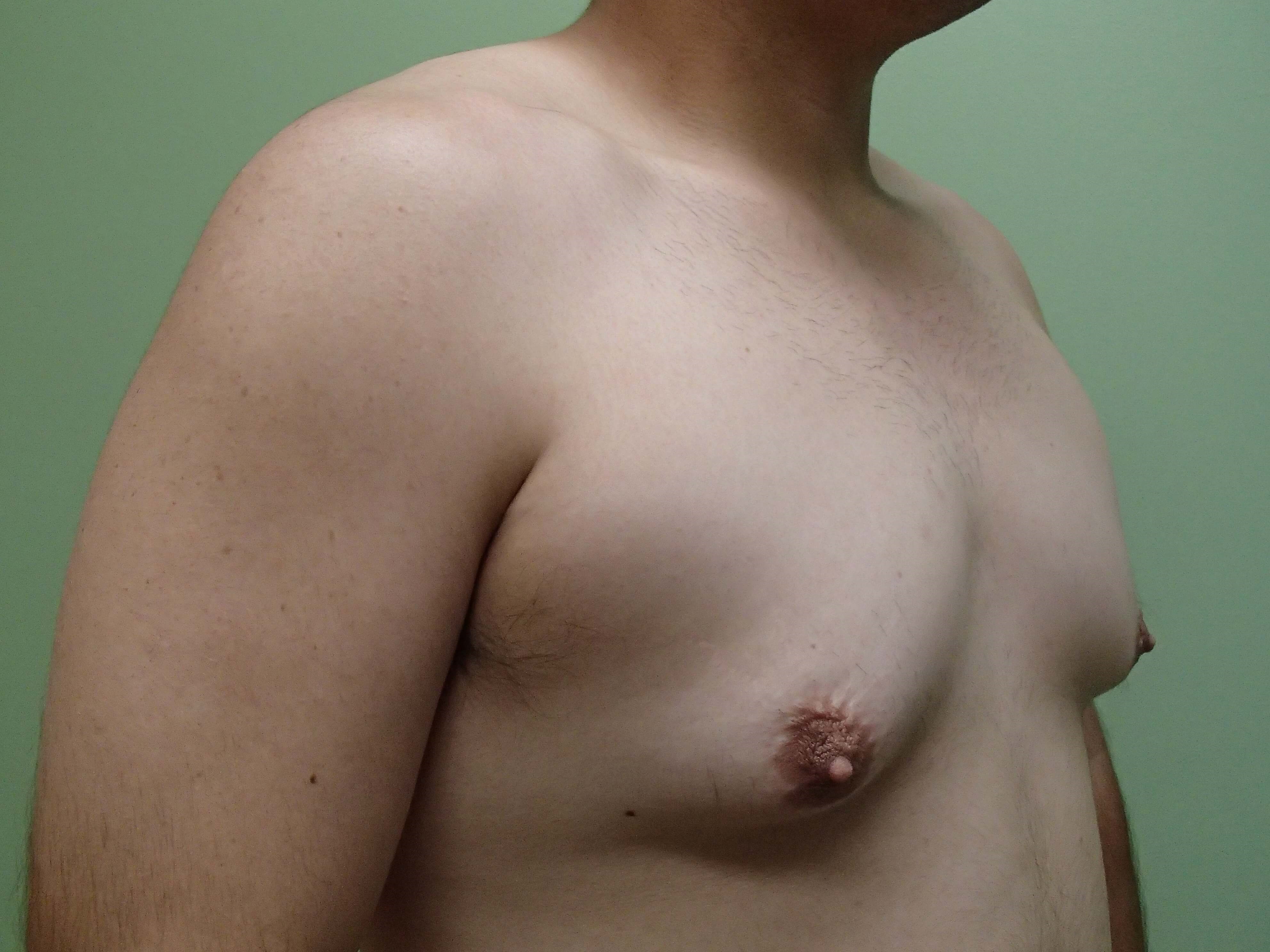 Gynecomastia (male breast redu Before