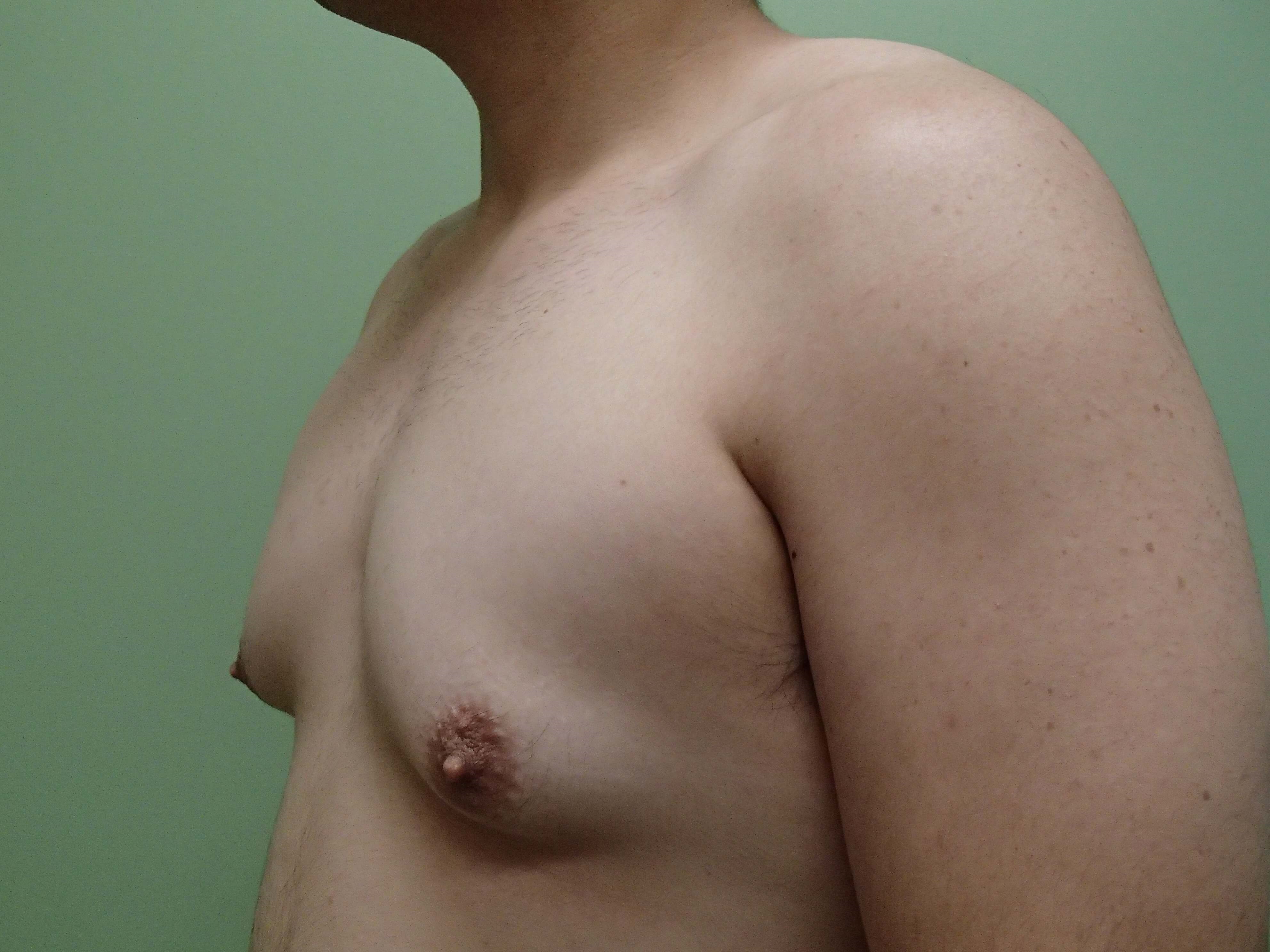 Gynecomastia (male breast redu Before