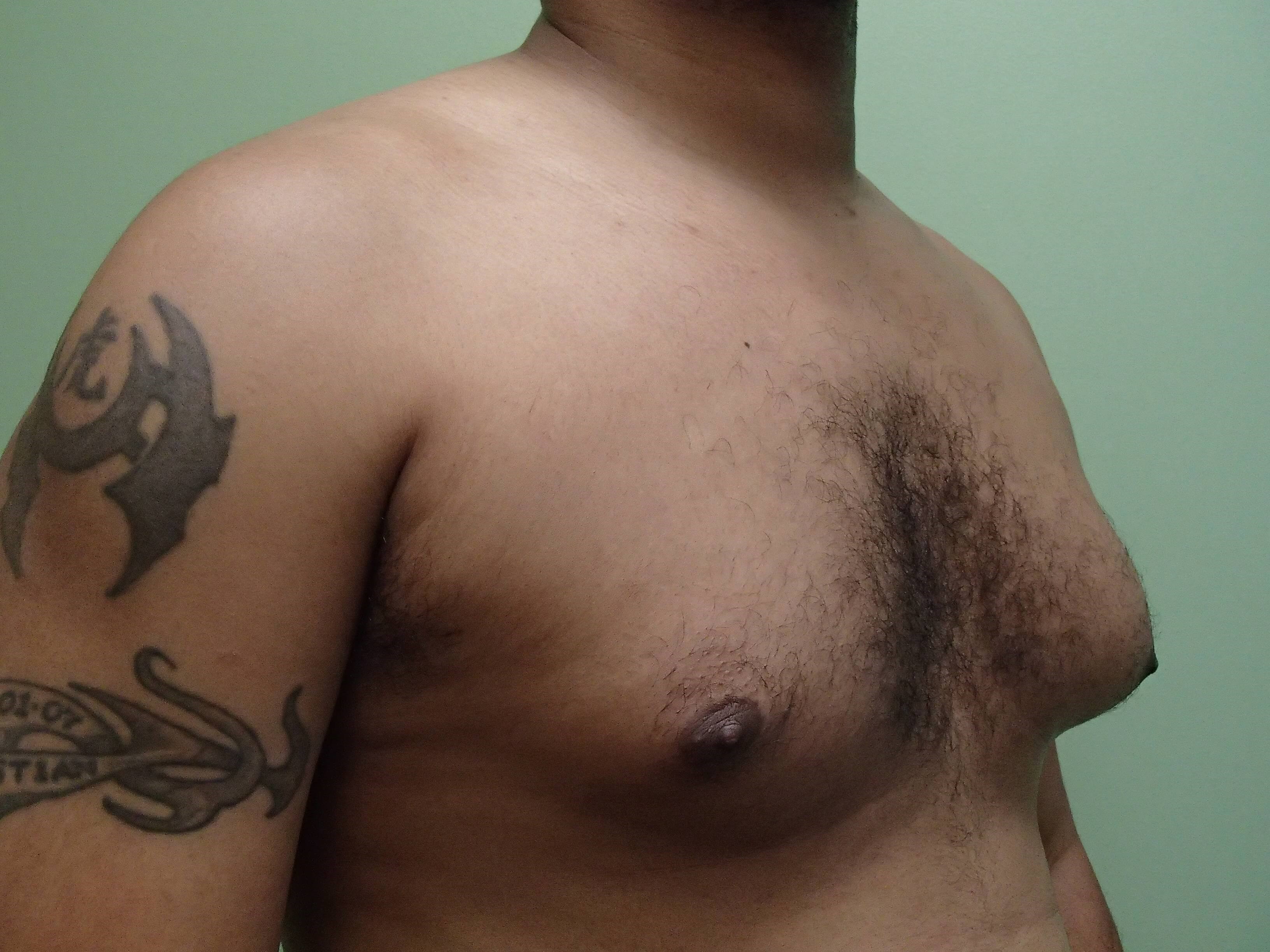 Gynecomastia (male breast redu Before