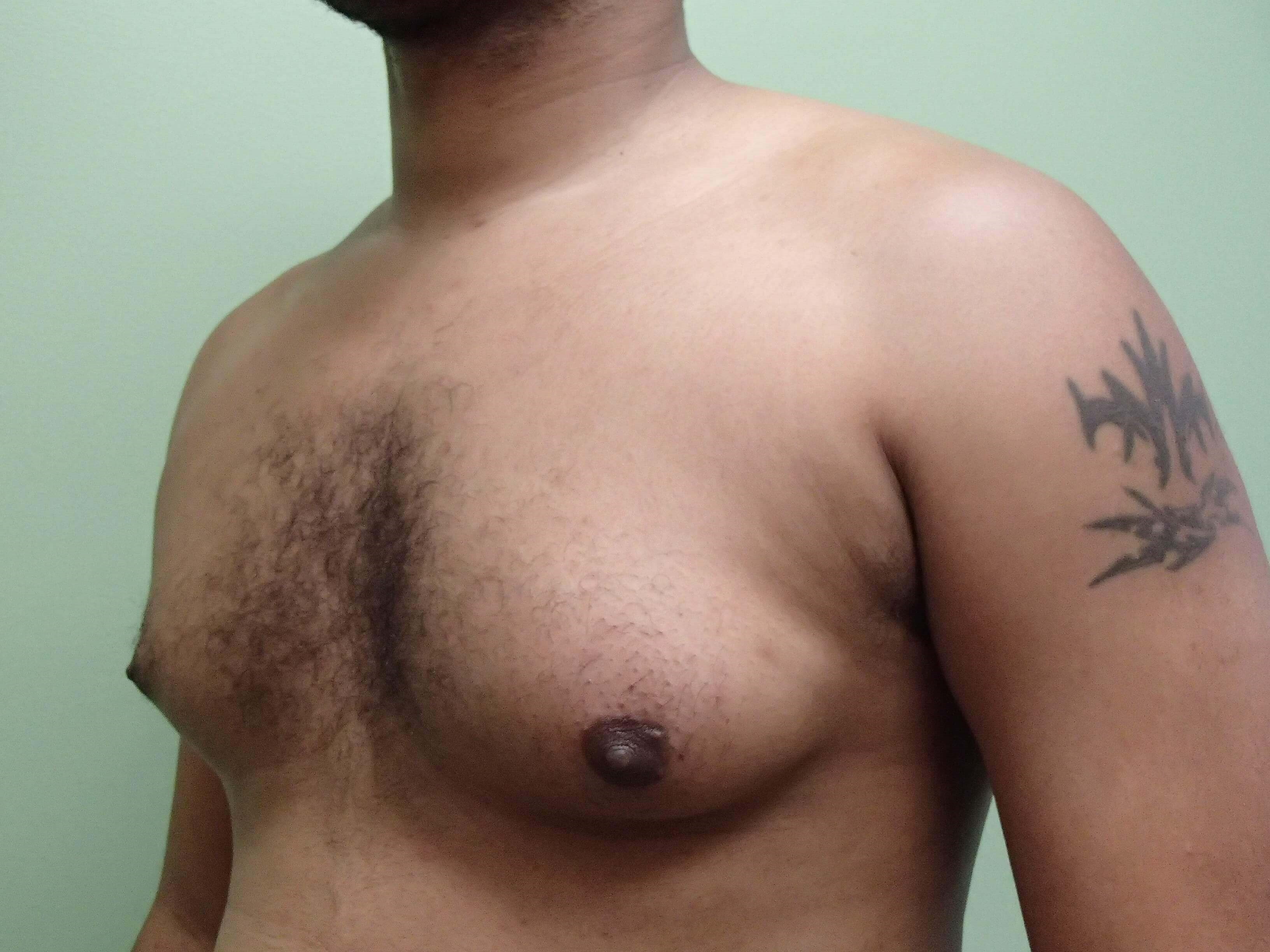 Gynecomastia (male breast redu Before