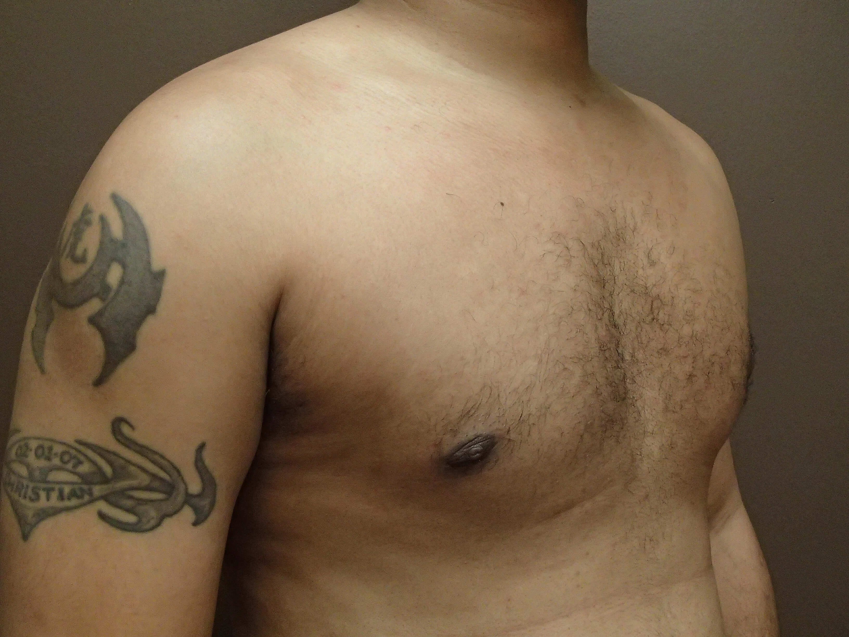 Gynecomastia (male breast redu After