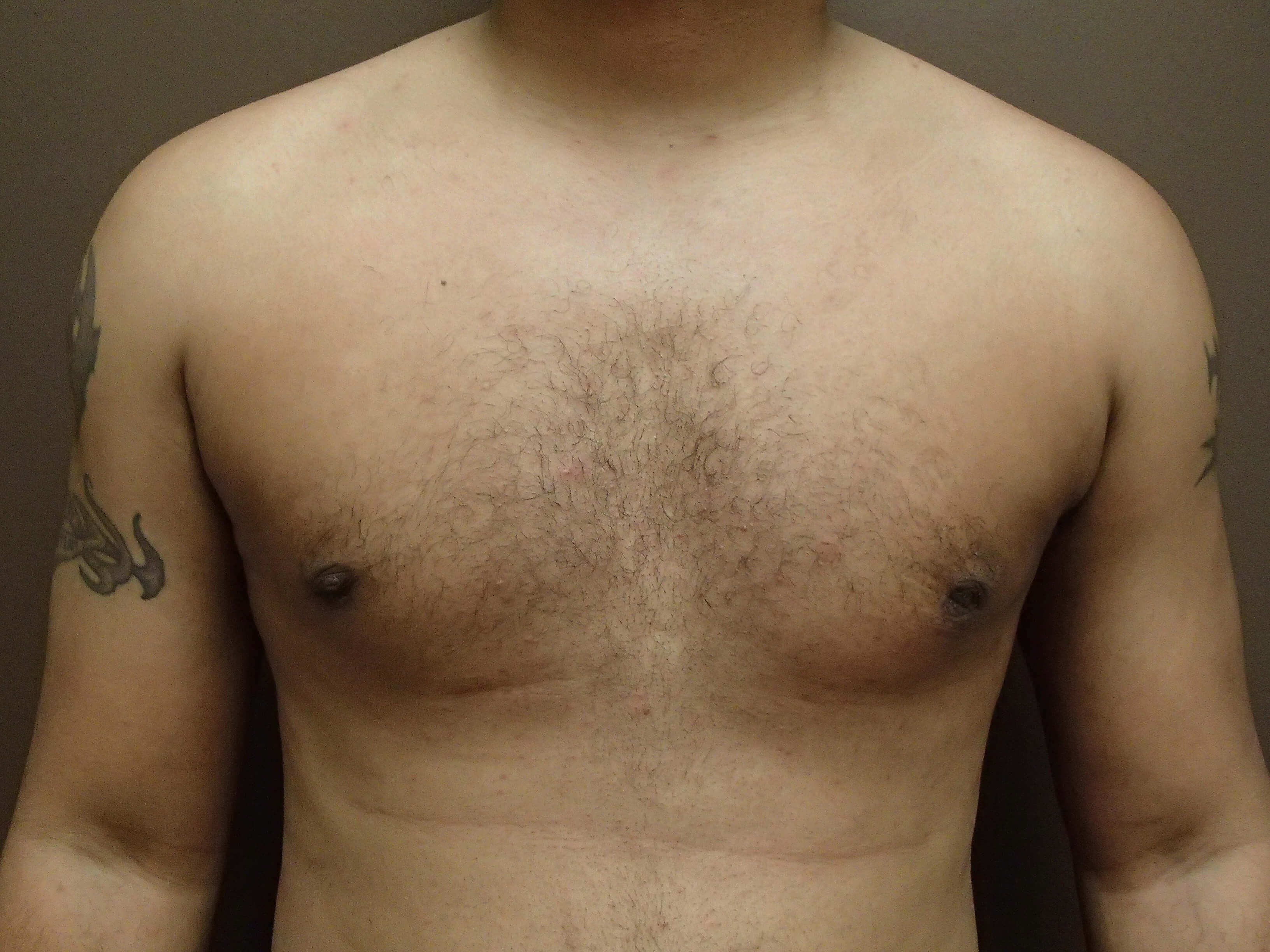 Gynecomastia (male breast redu After