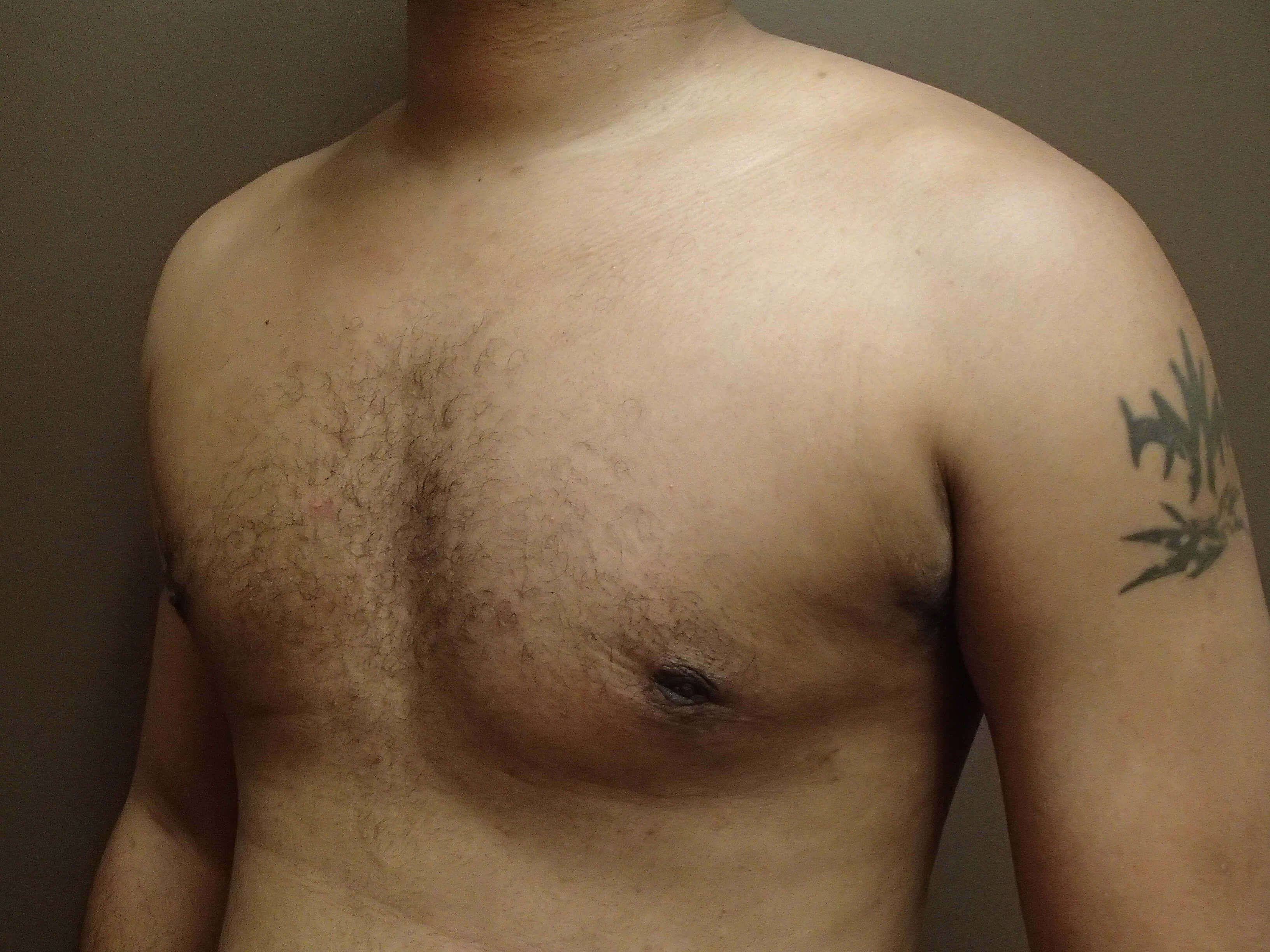 Gynecomastia (male breast redu After