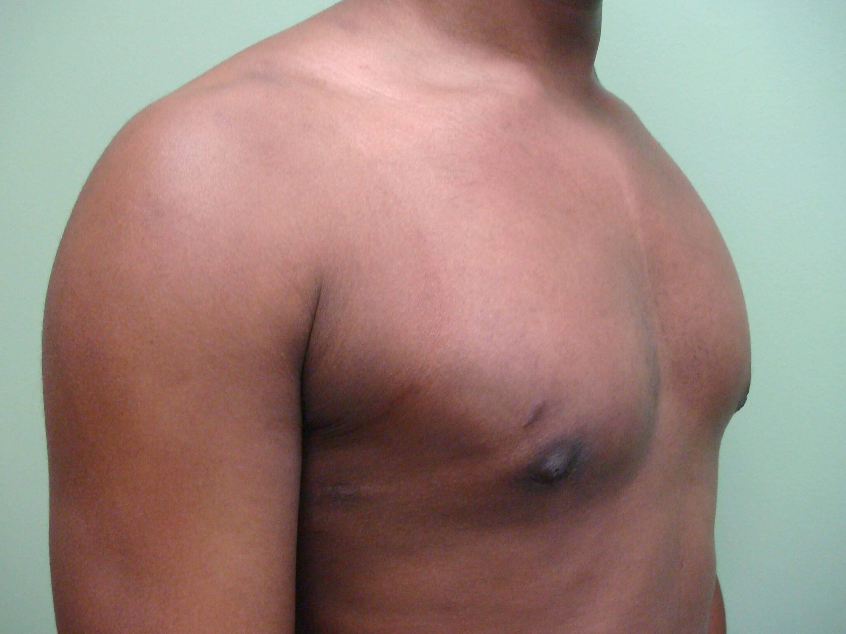 Gynecomastia (male breast redu After