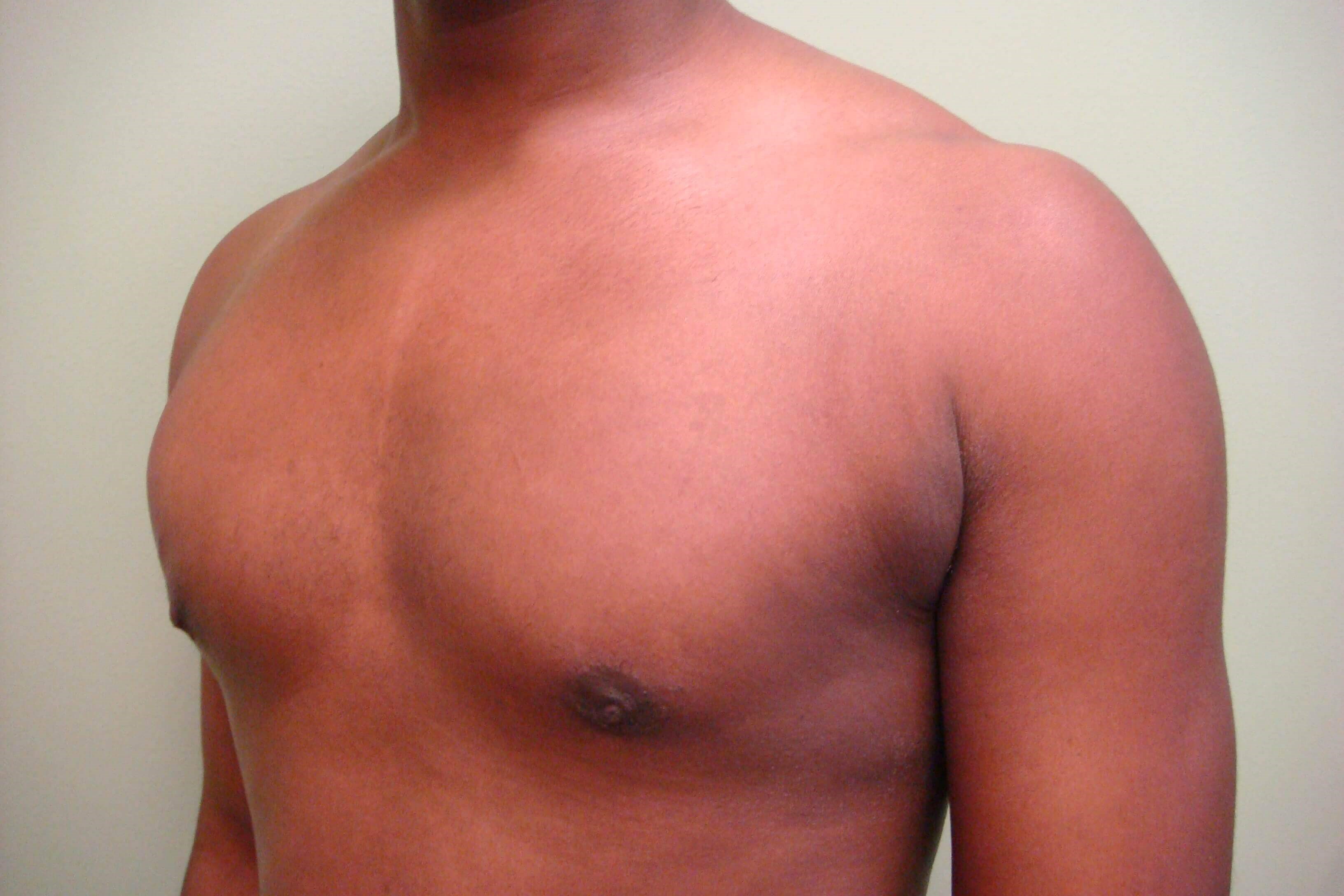 Gynecomastia (male breast redu After