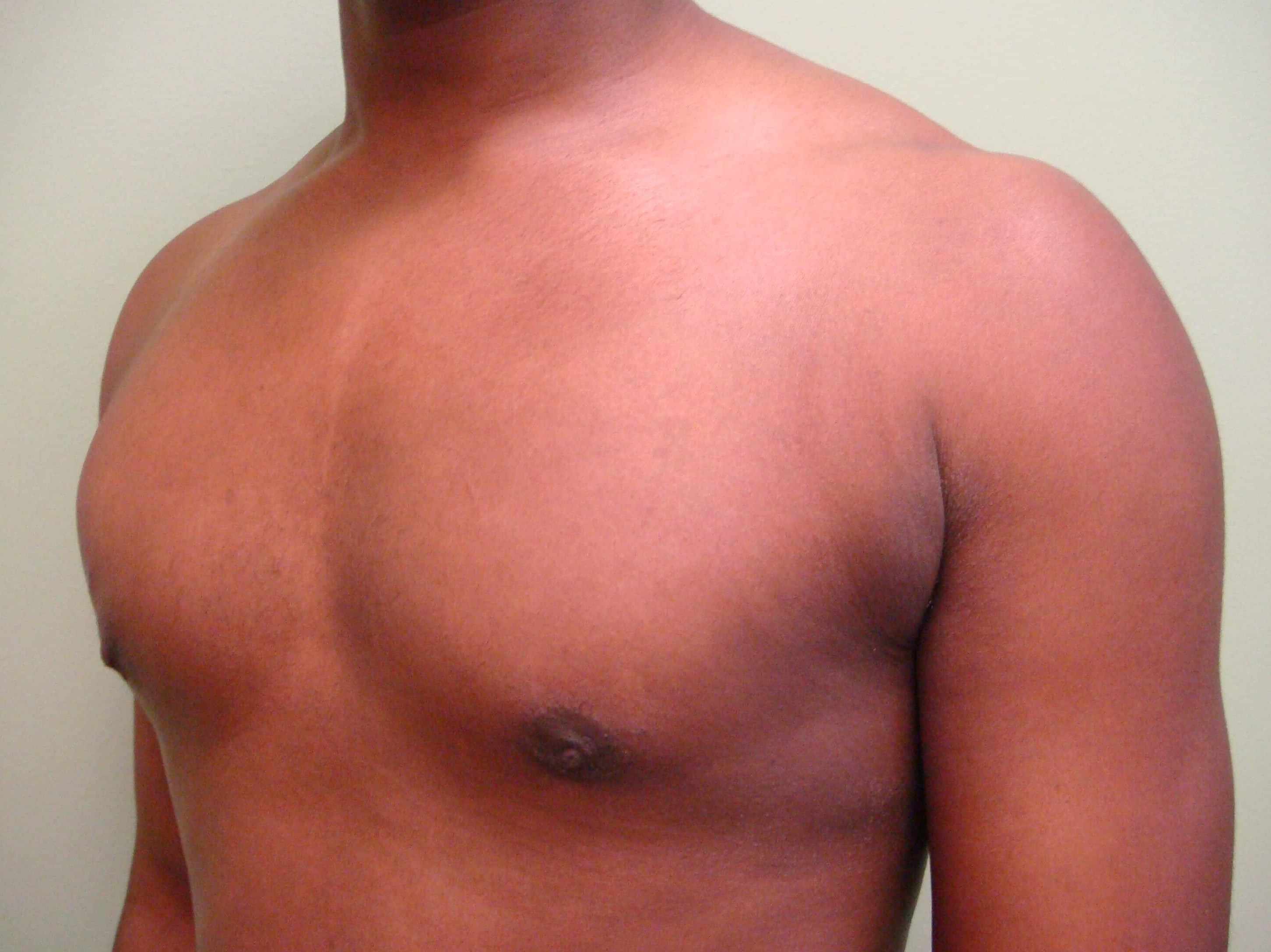 Gynecomastia (male breast redu After