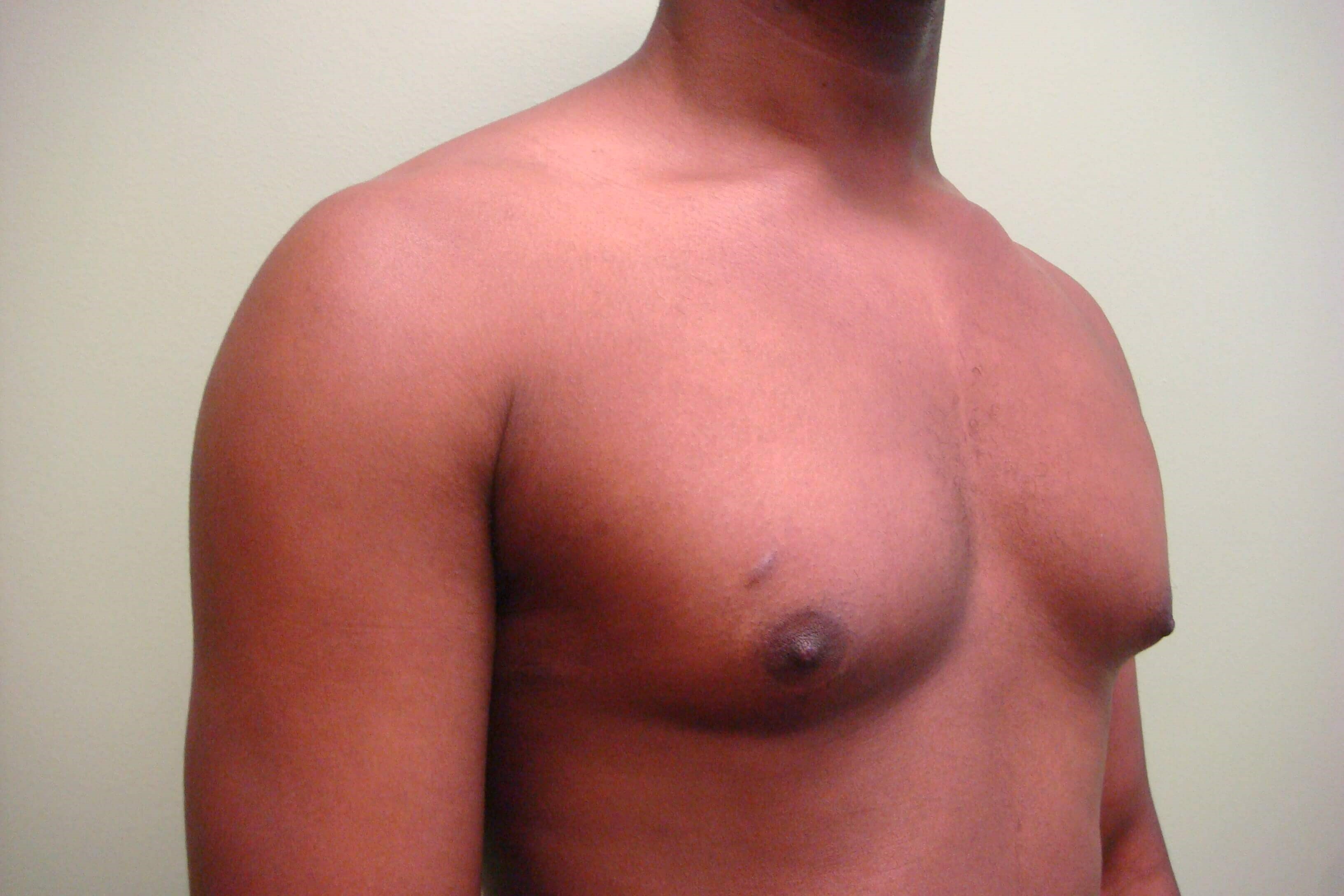 Gynecomastia (male breast redu Before