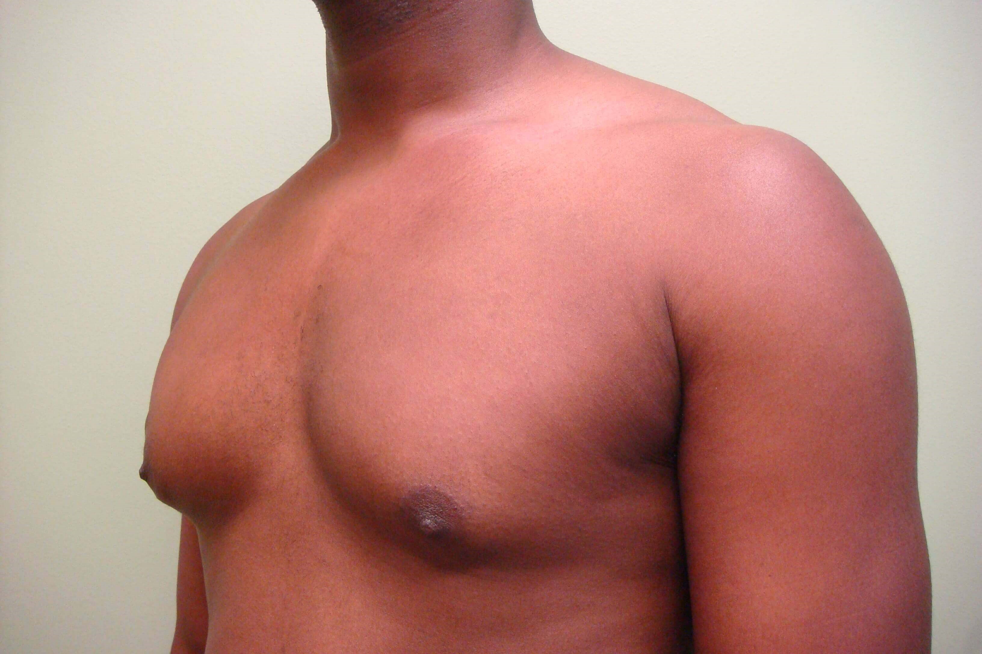 Gynecomastia (male breast redu Before