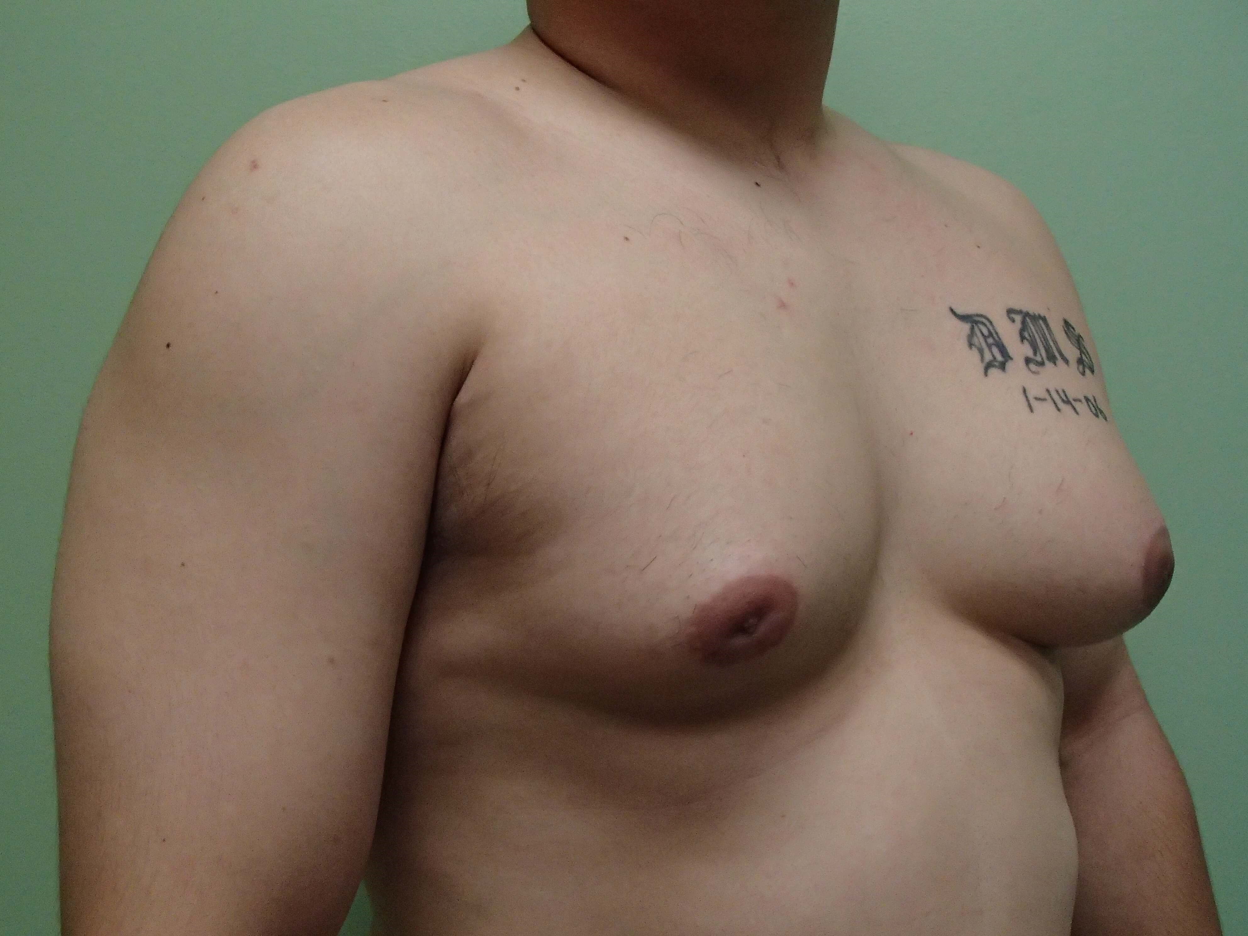 Gynecomastia (male breast redu Before