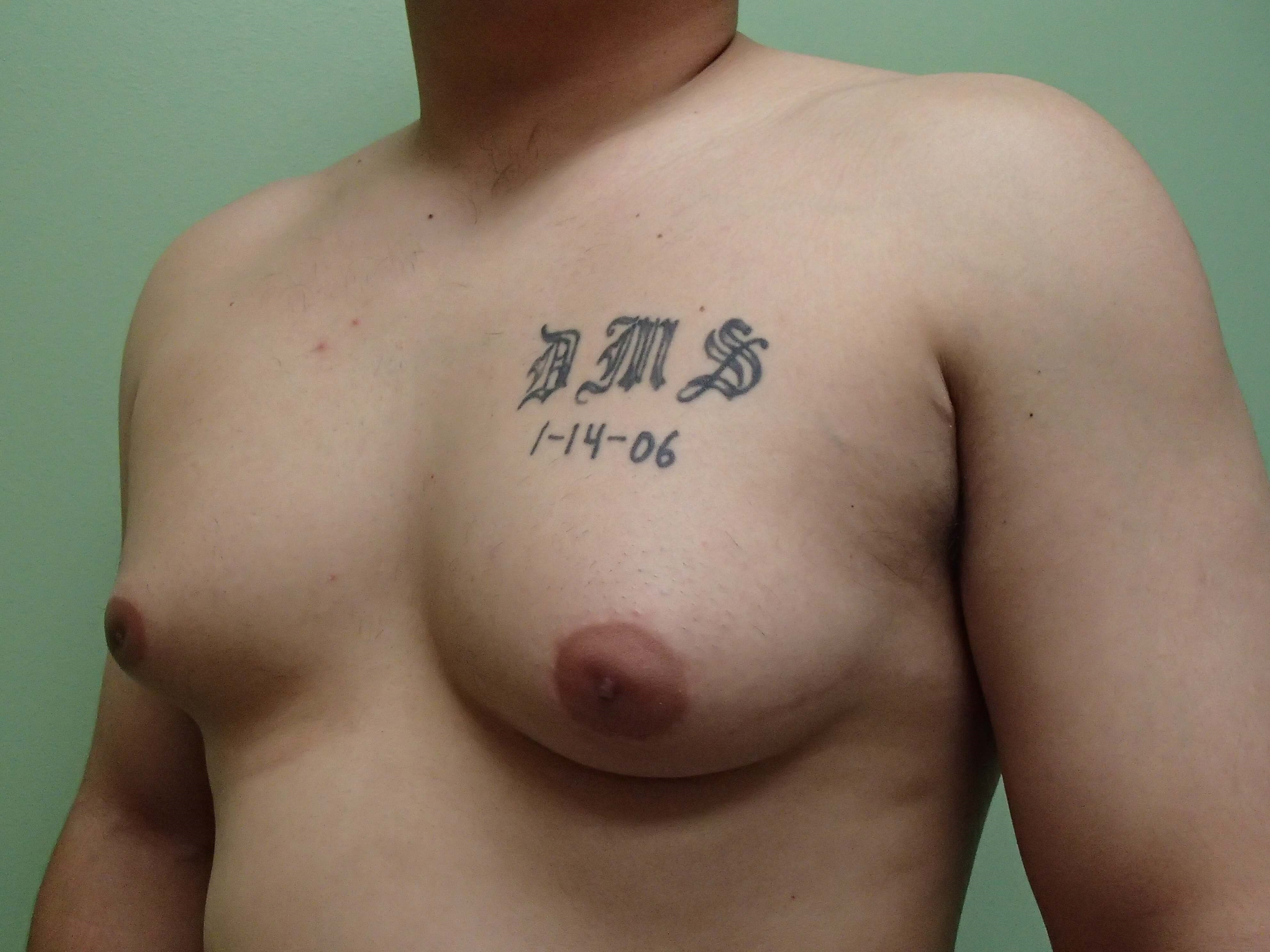 Gynecomastia (male breast redu Before