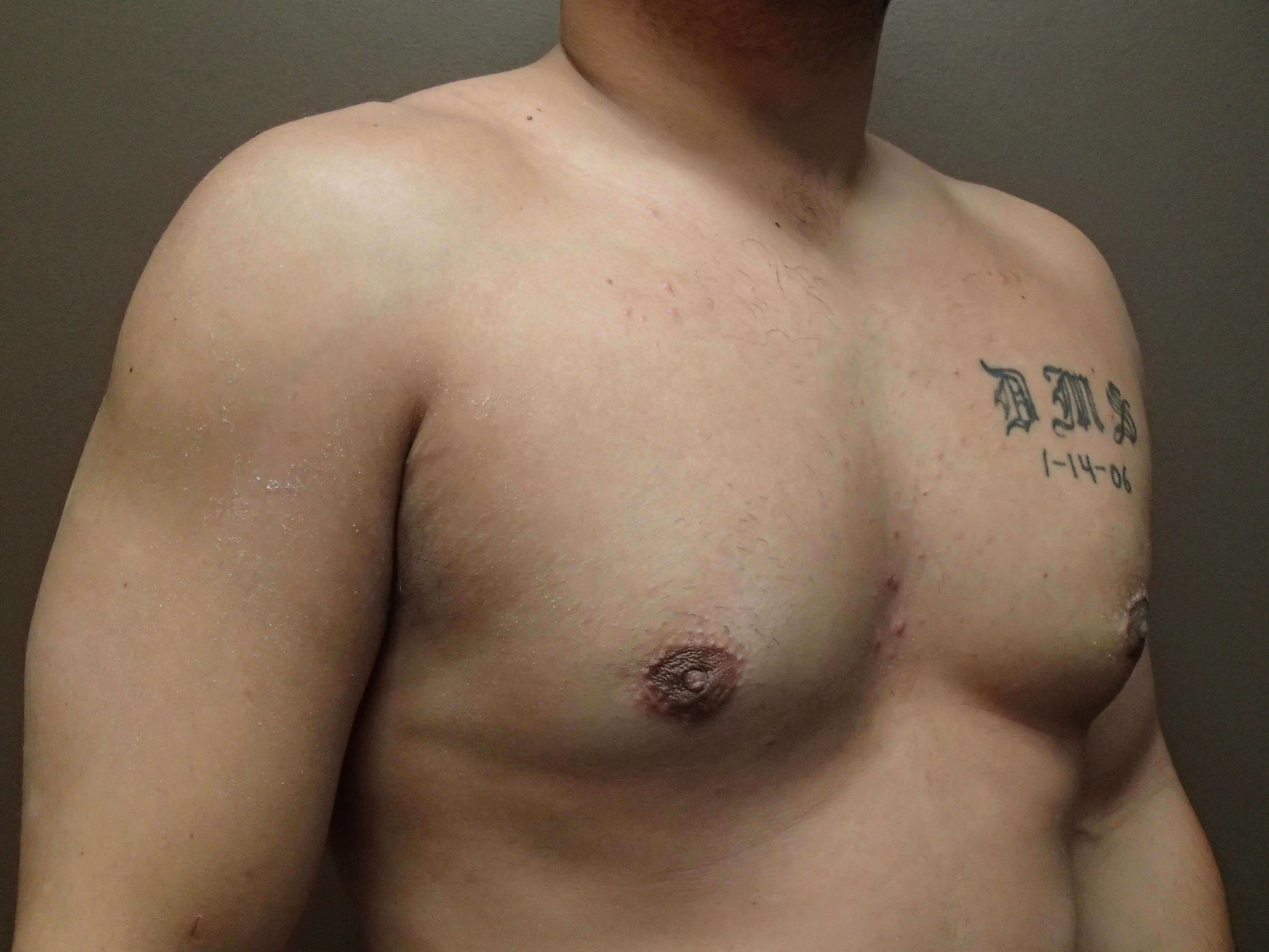 Gynecomastia (male breast redu After